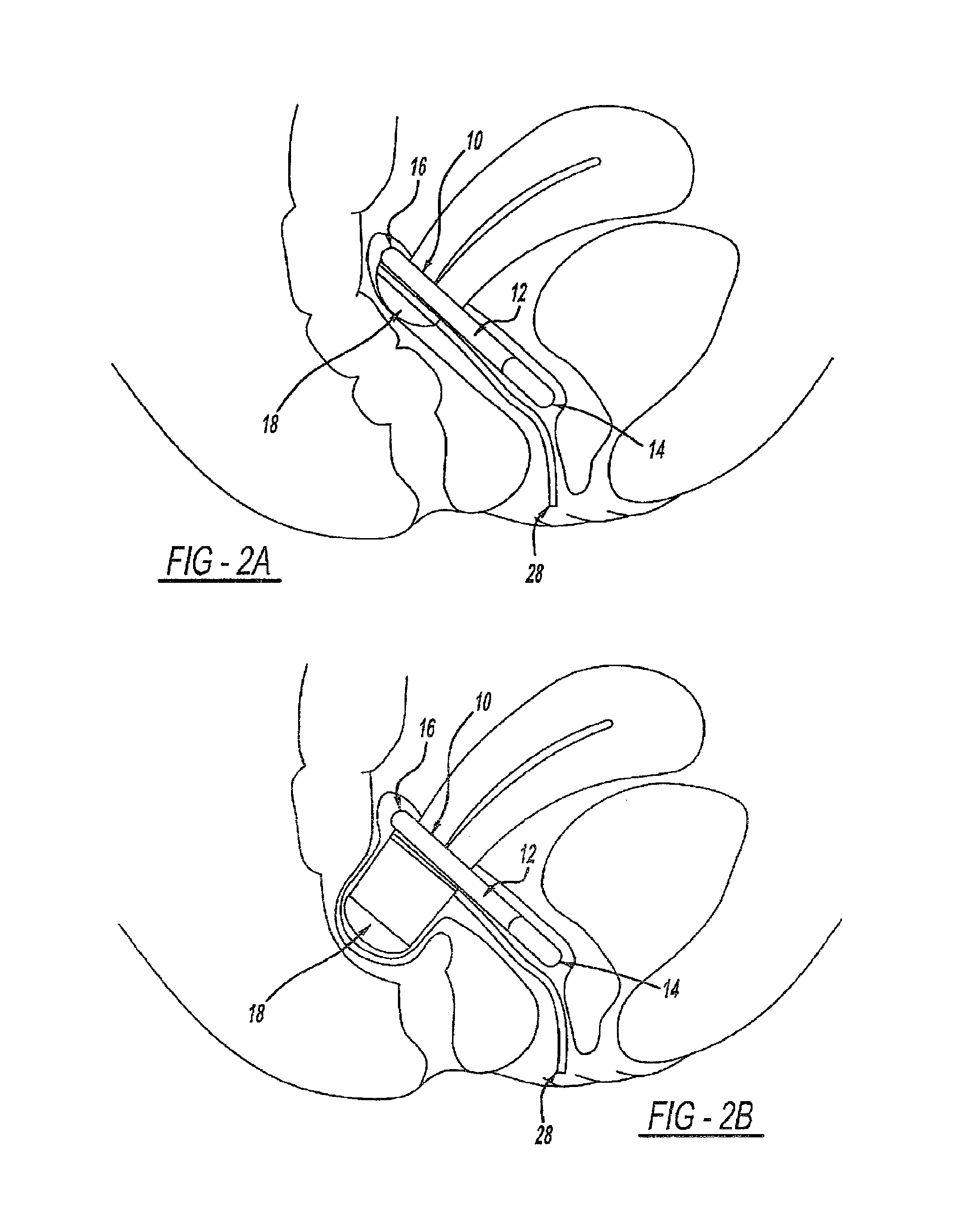 Intra-Vaginal Device For Fecal Incontinence