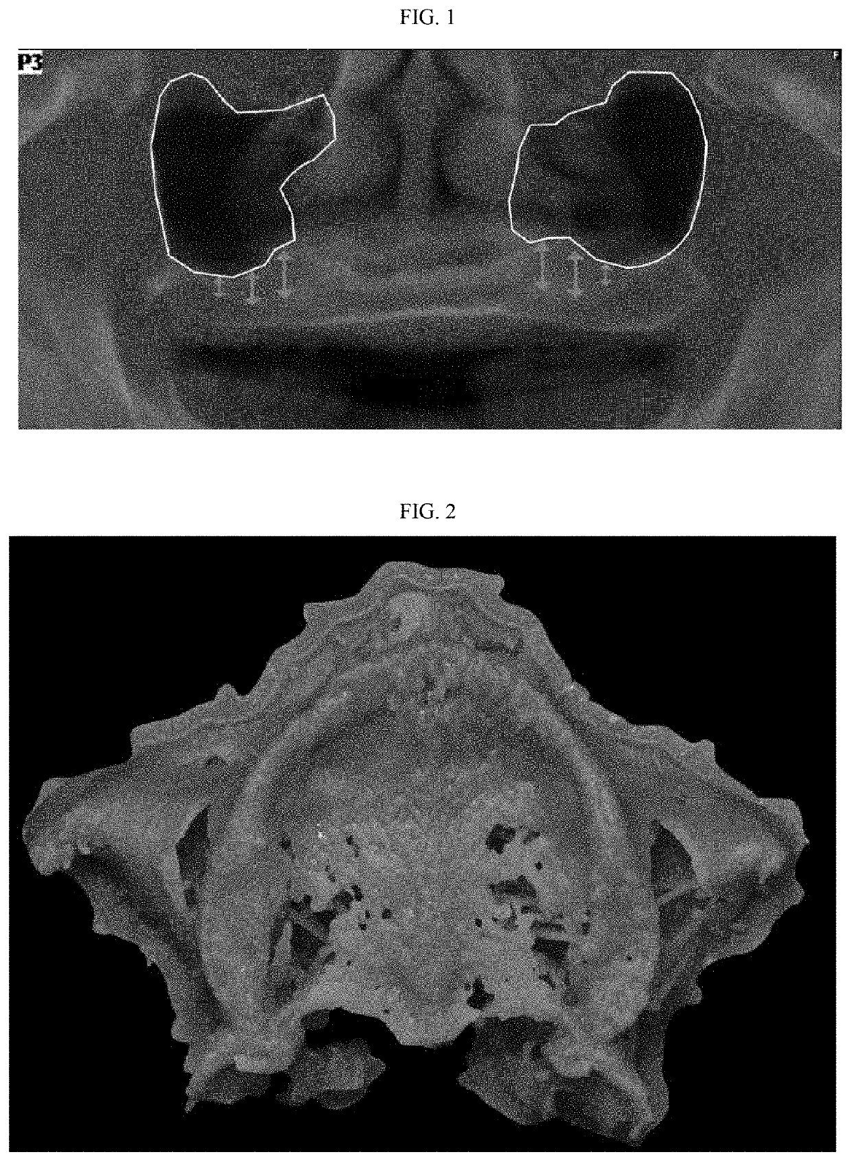 Three-dimensional printed bone supported sinus guide for edentulous maxillary arch