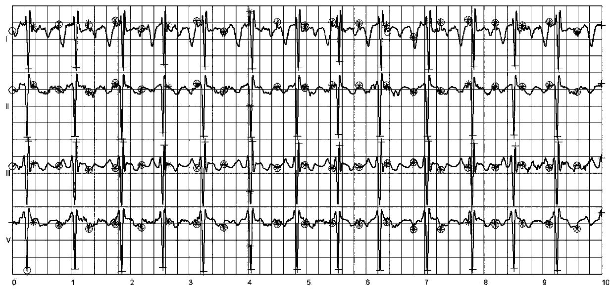 A Fetal Heart Rate Extraction Method Based on Maternal ECG Signal