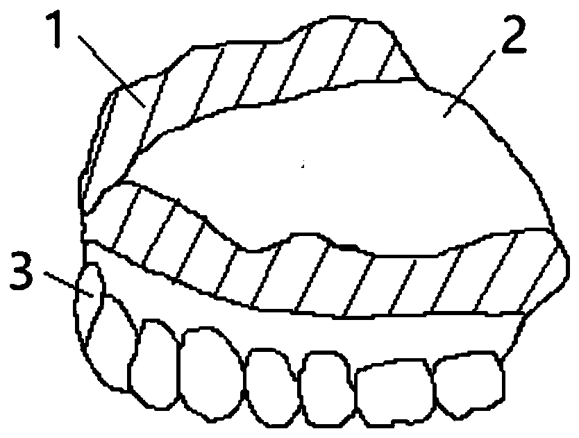 A kind of complete denture and preparation method thereof