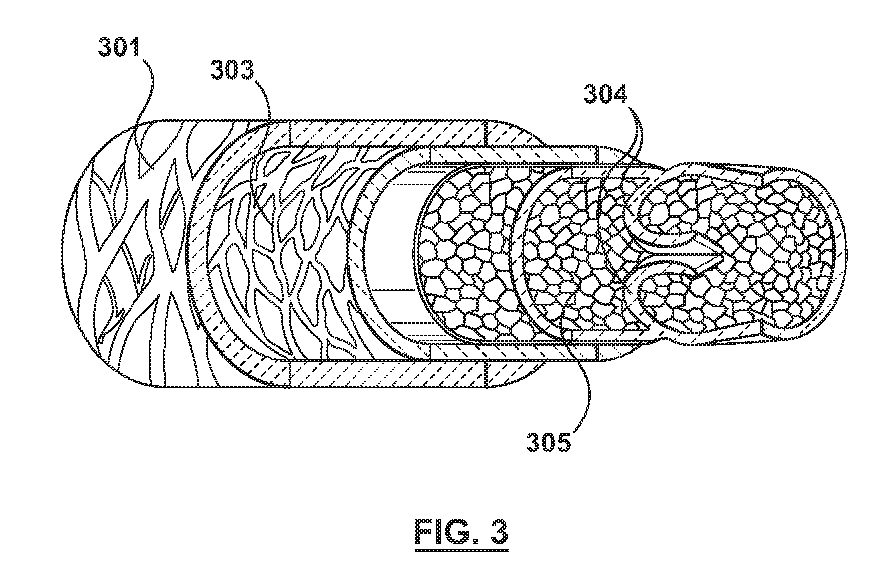 Percutaneous methods for apparatus for creating native tissue venous valves