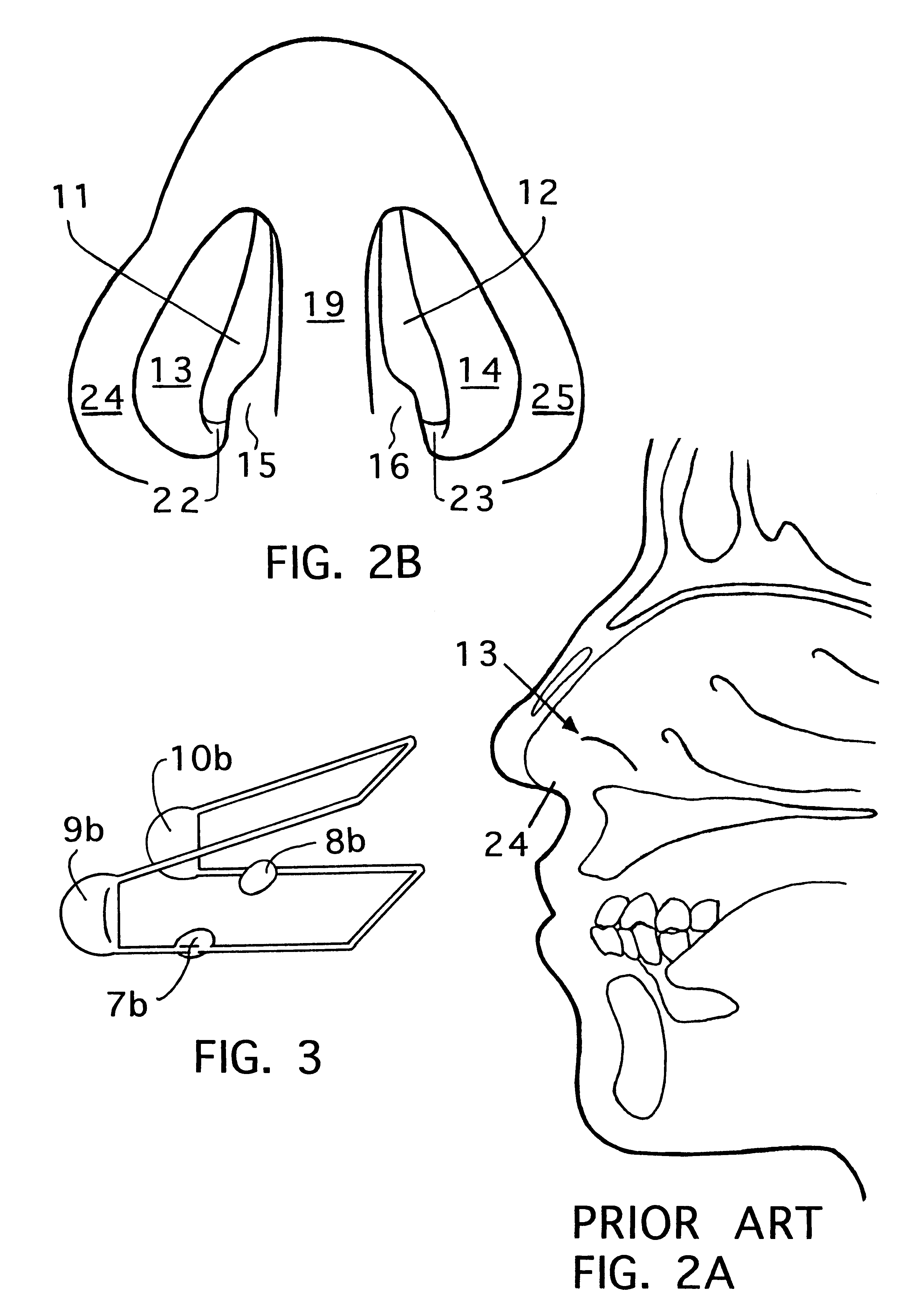 Internal nasal dilator