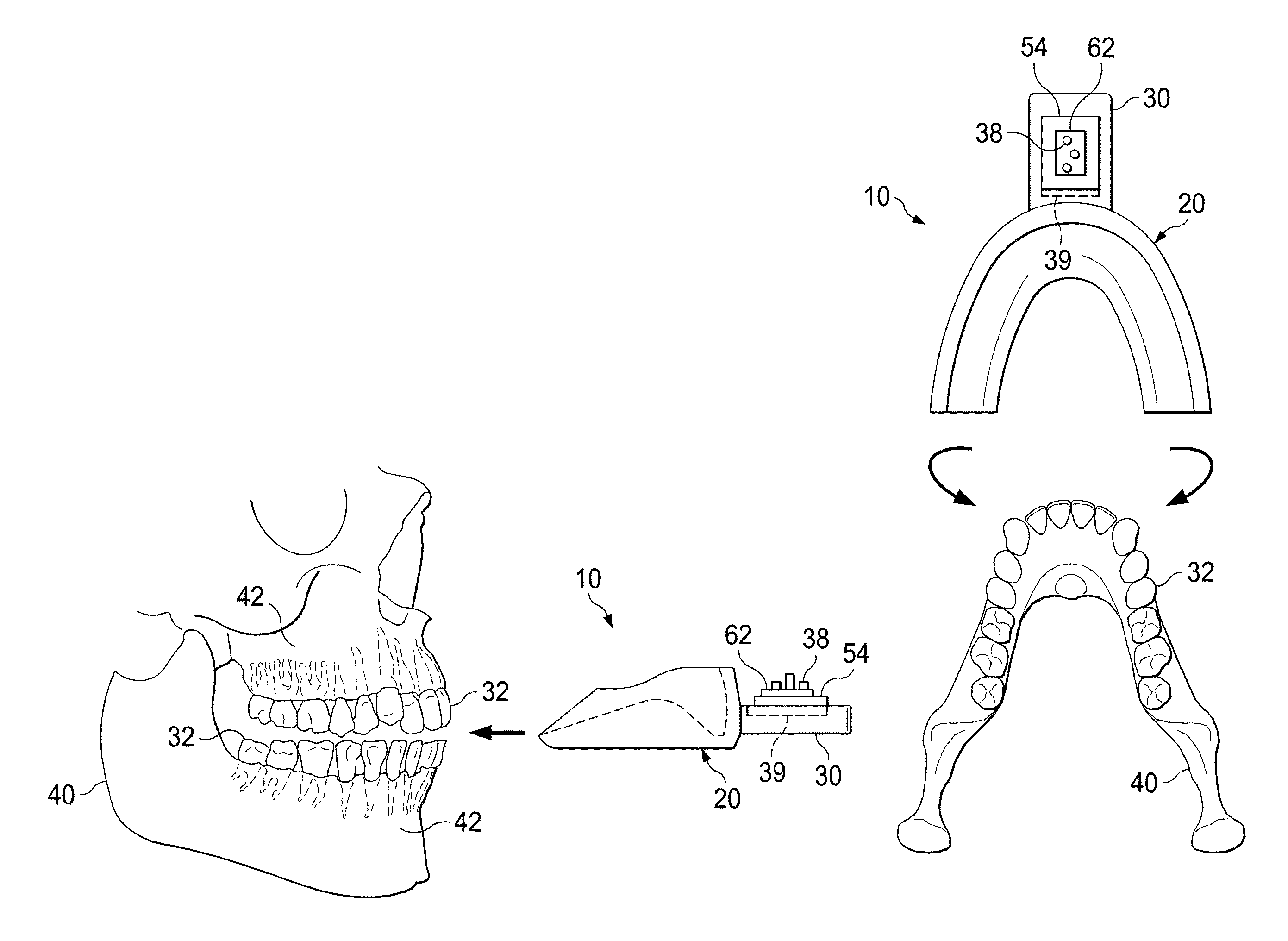Vibrating orthodontic remodelling device