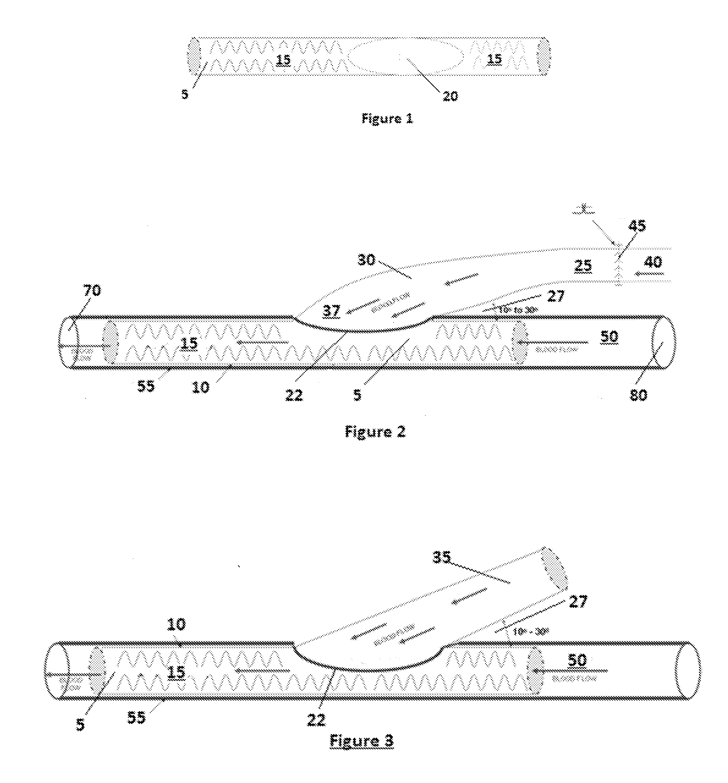Device and method to prevent or treat outflow vein stenosis of an arteriovenous fistula constructed with a synthetic vascular graft