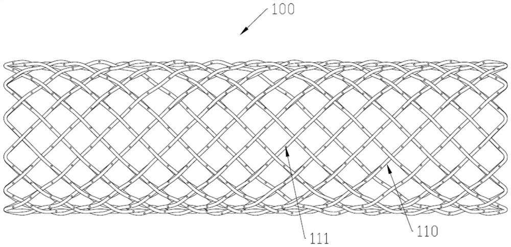 Weaved stent and woven stent system