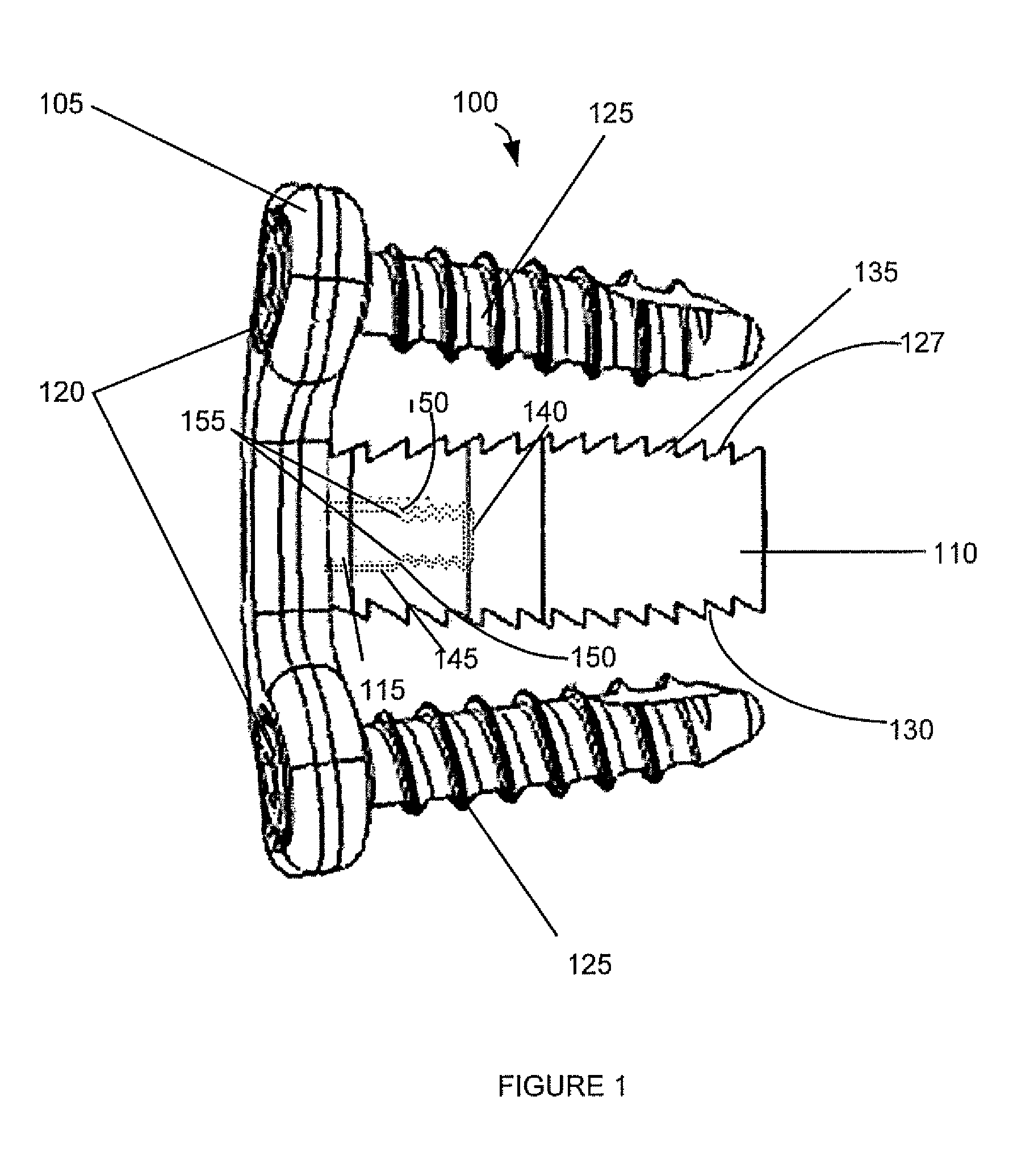 Spinal interbody system and method