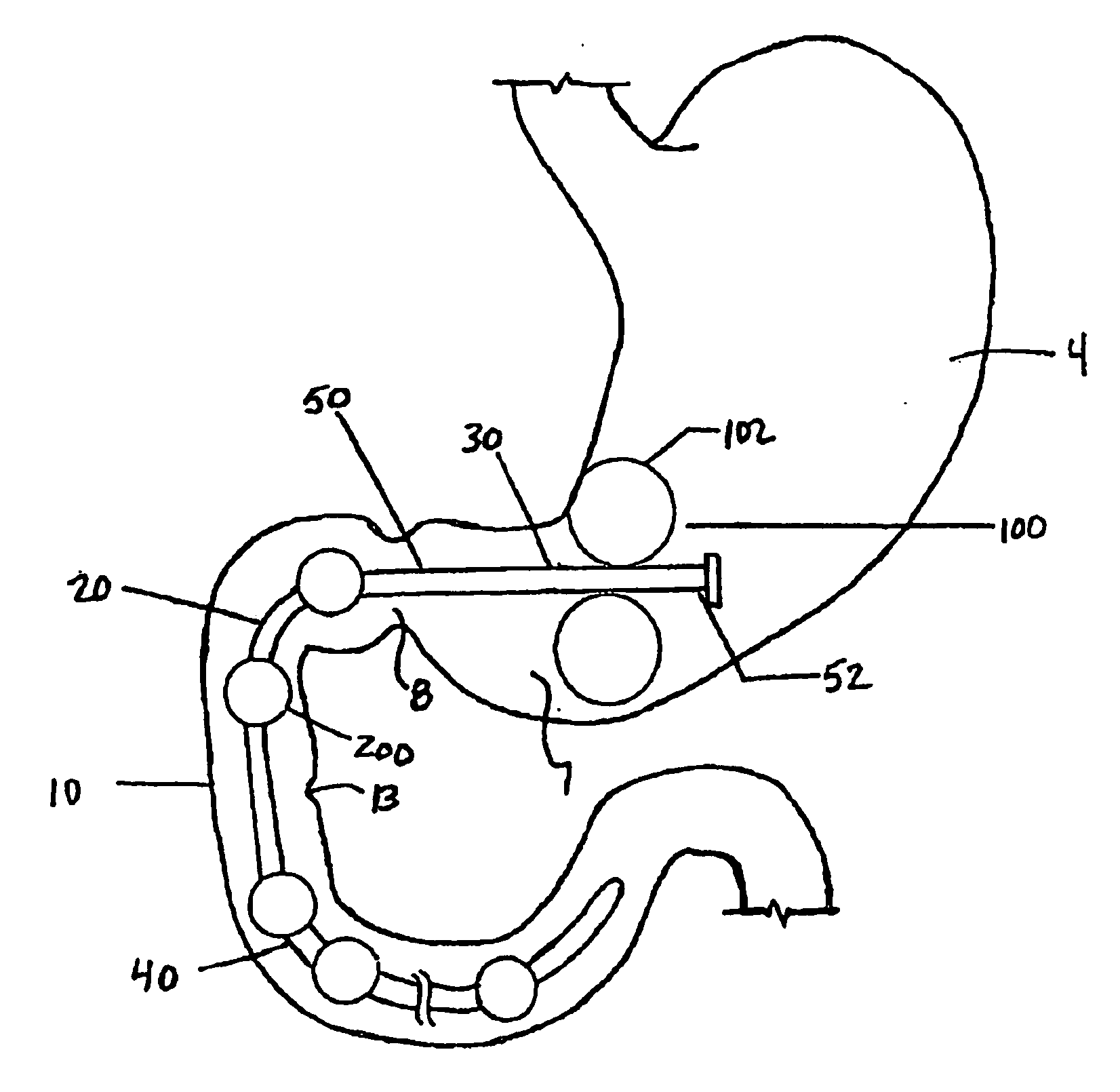 Methods and devices to curb appetite and/or to reduce food intake