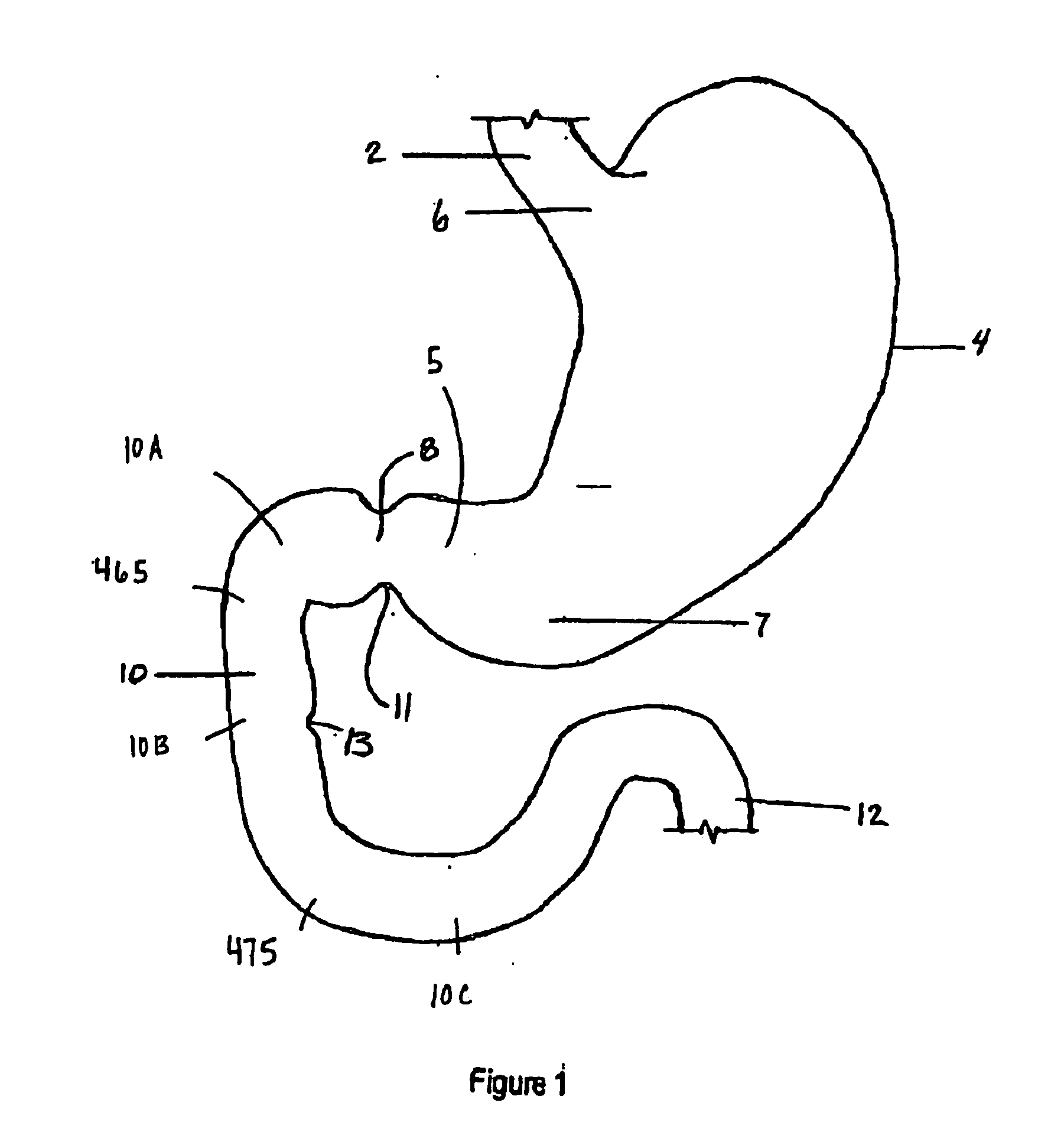 Methods and devices to curb appetite and/or to reduce food intake