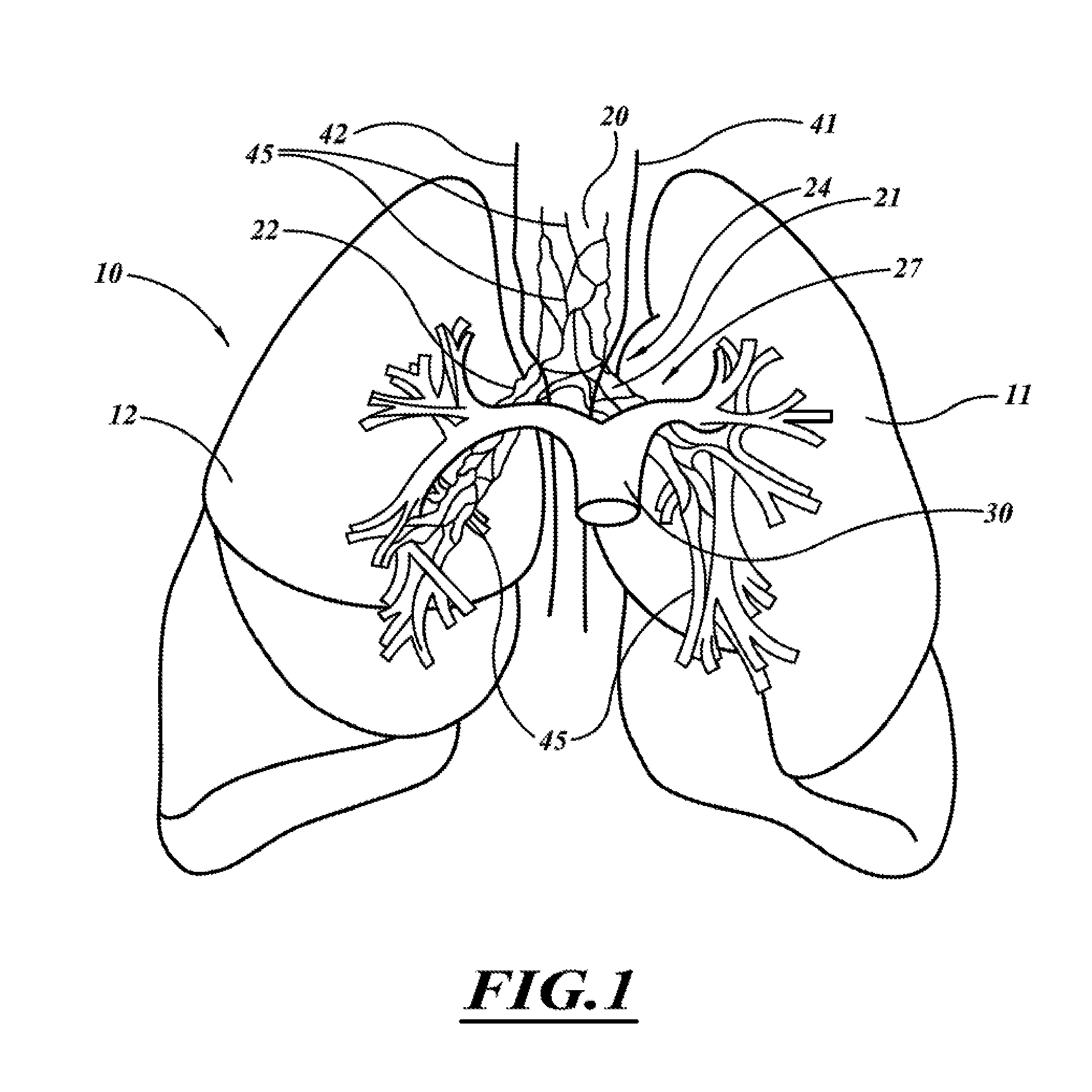 Systems, devices, and methods for treating a pulmonary disease with ultrasound energy