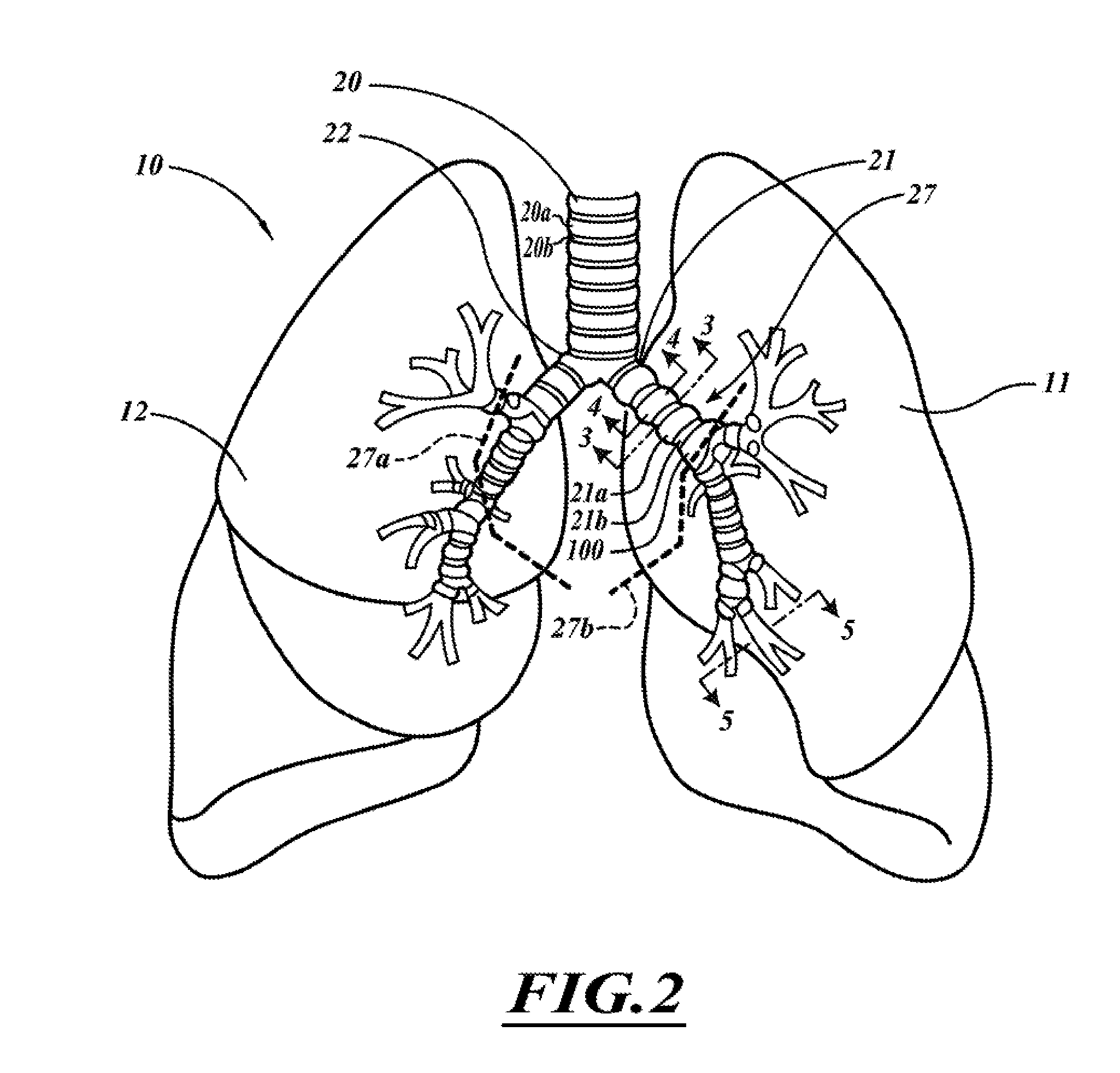 Systems, devices, and methods for treating a pulmonary disease with ultrasound energy