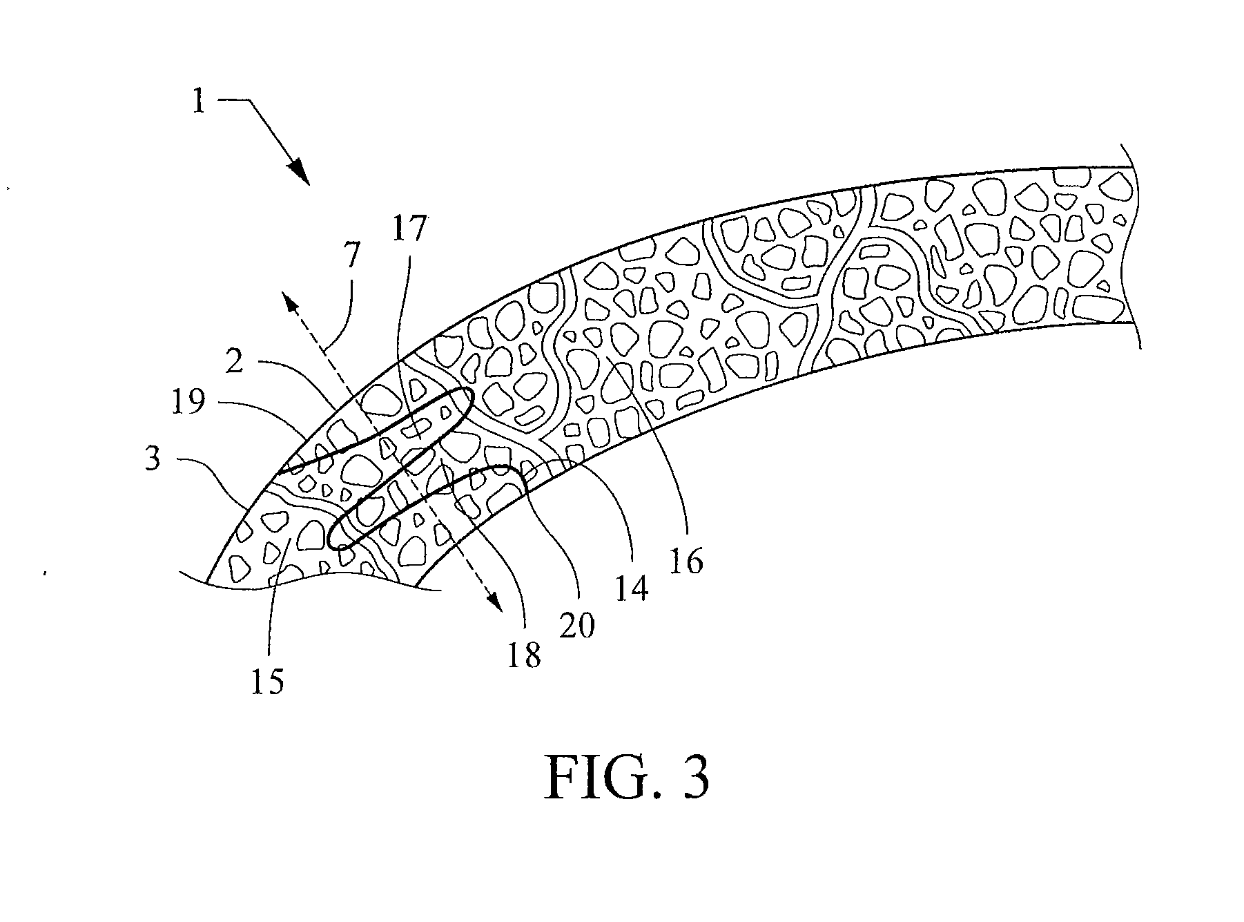 Laser system and method for performing and sealing corneal incisions in the eye