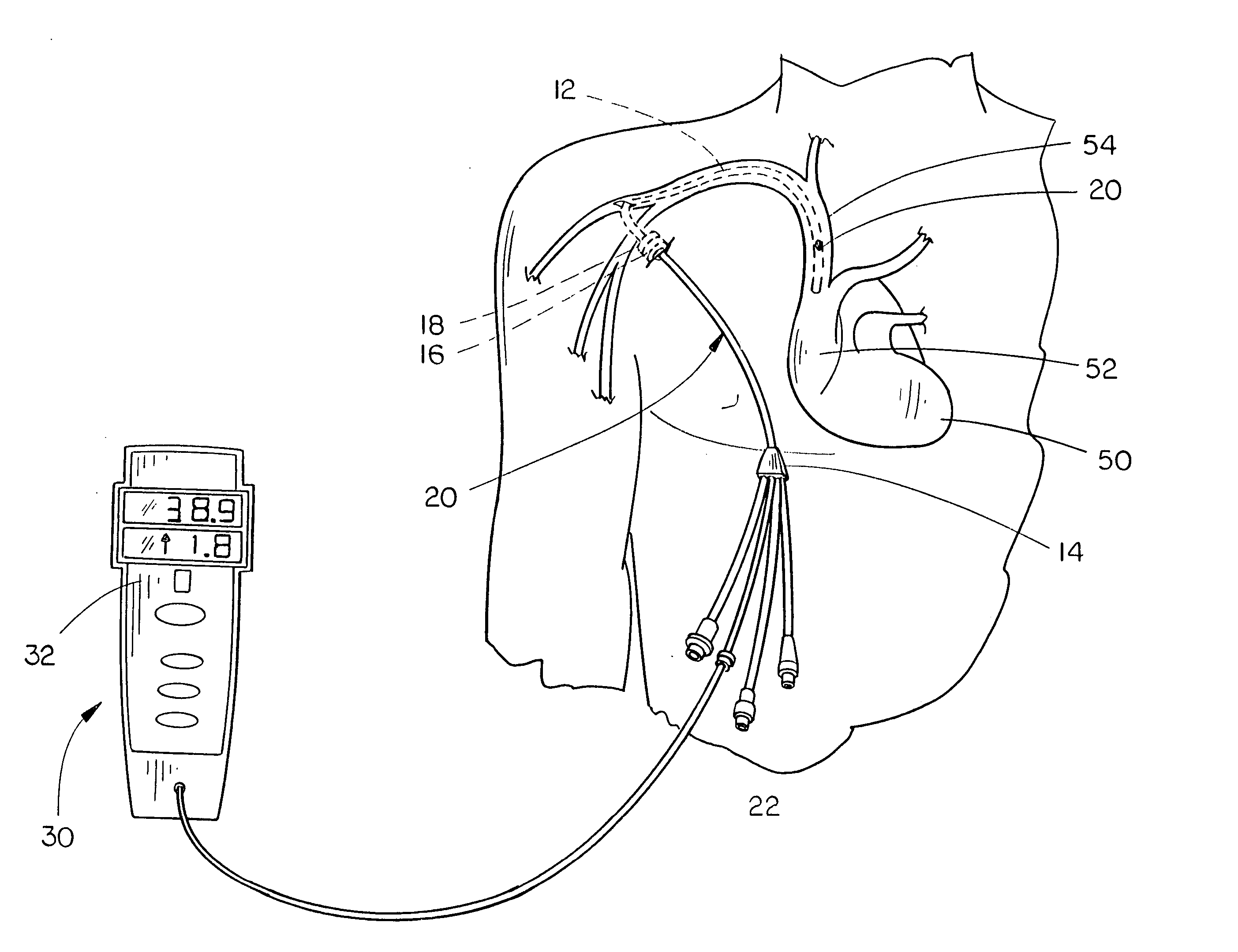 Modified hickman-type catheter with embedded thermistor