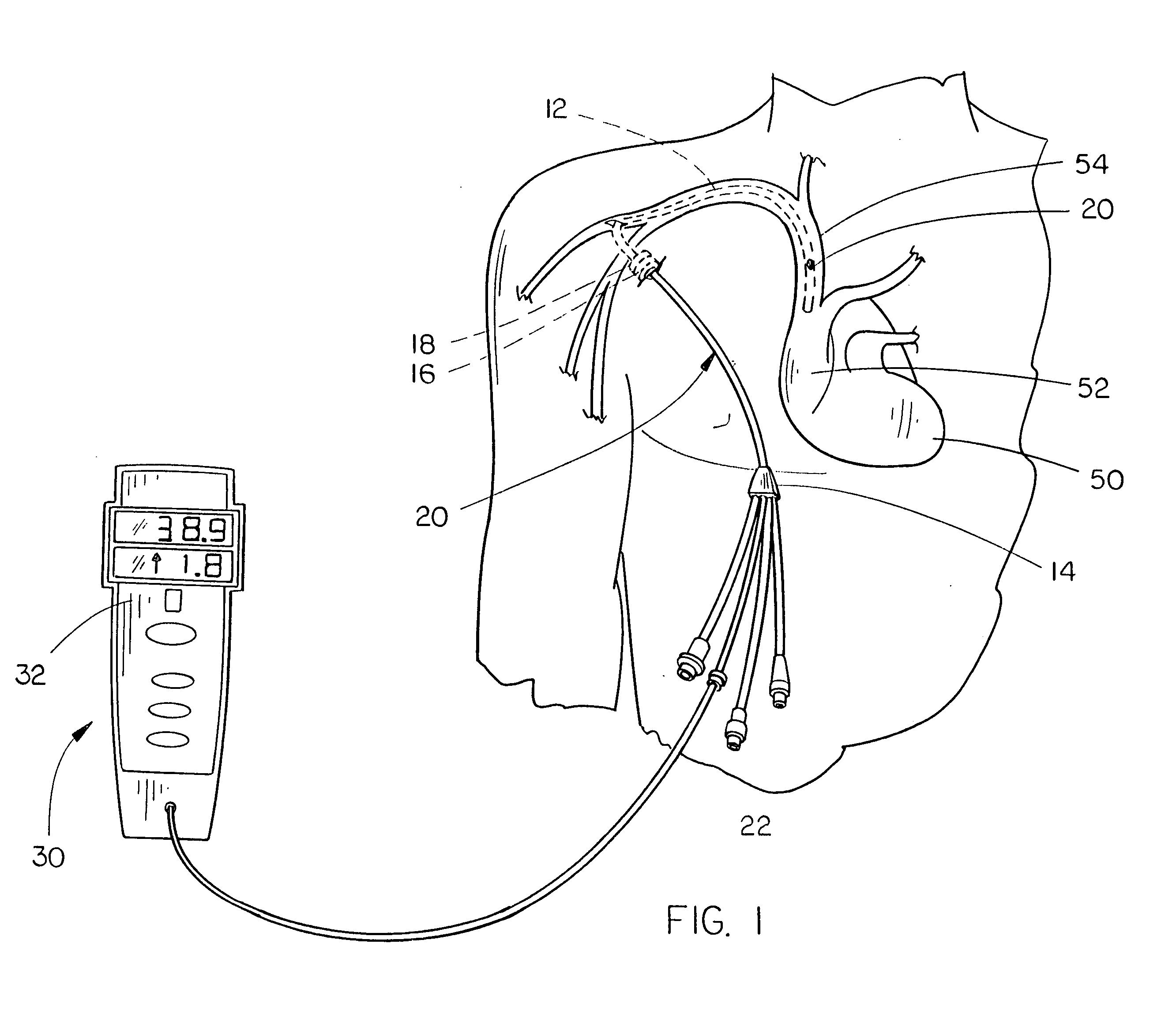 Modified hickman-type catheter with embedded thermistor