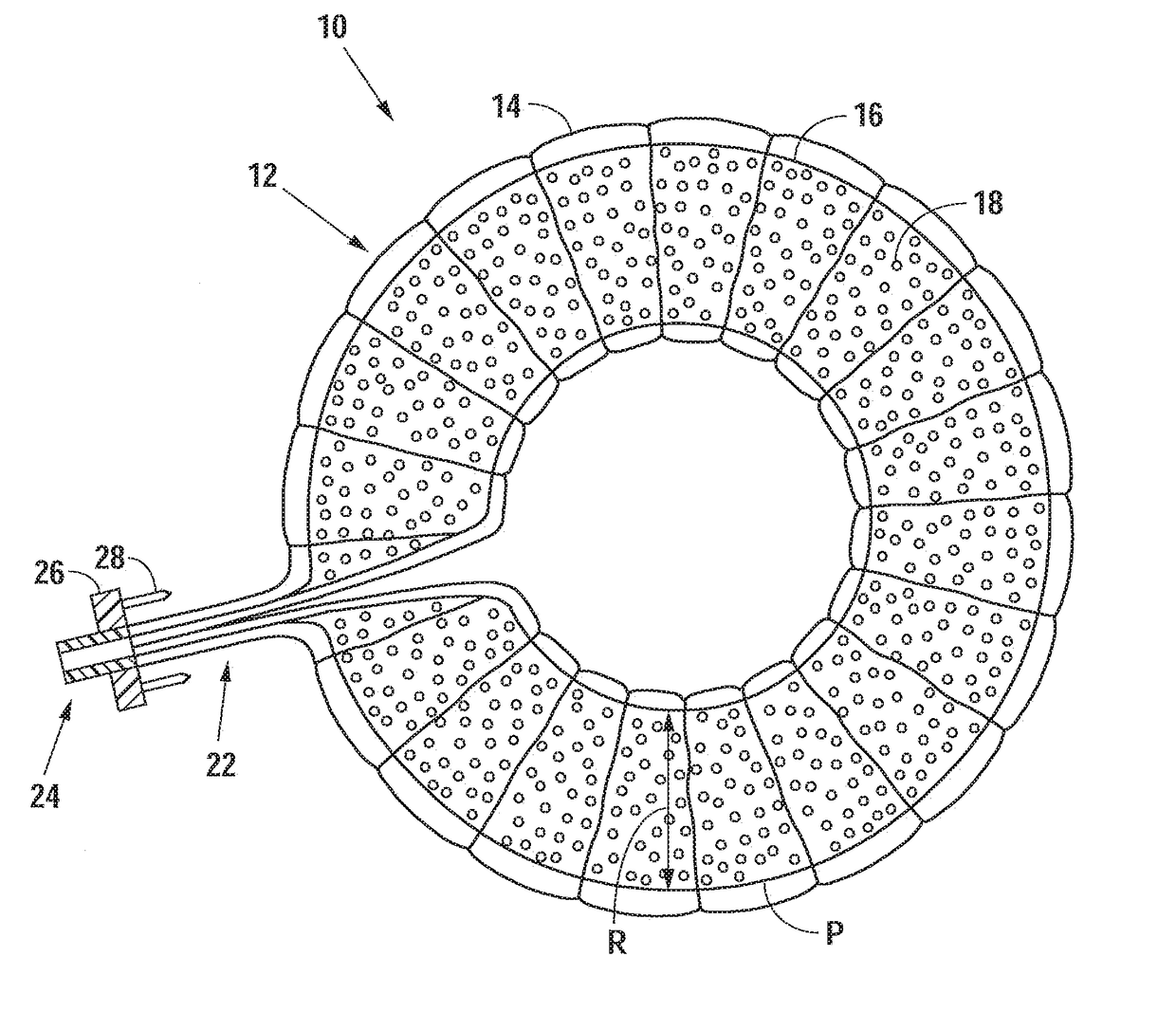 Radially Expandable Annulus Reinforcement Prosthesis