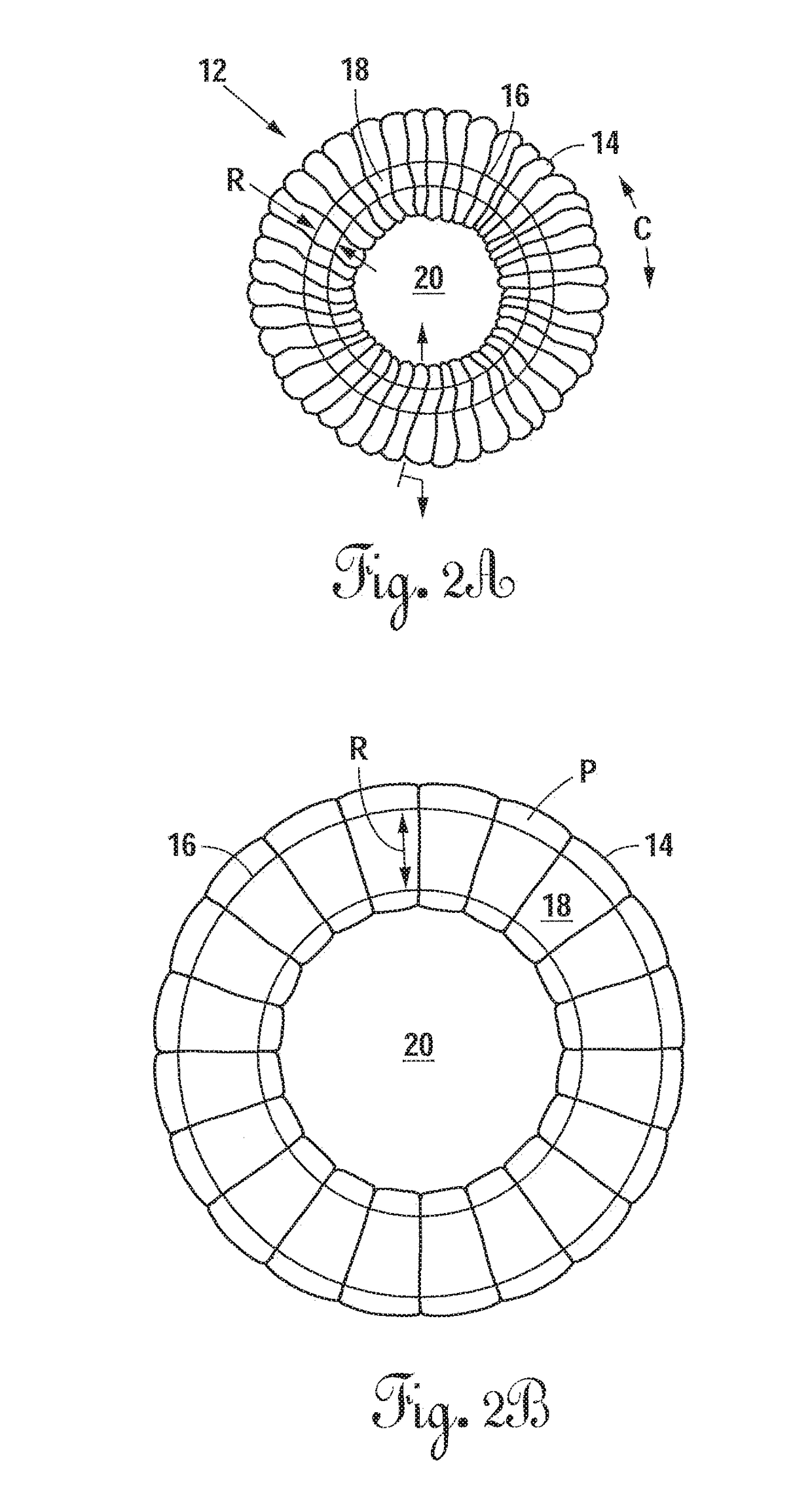 Radially Expandable Annulus Reinforcement Prosthesis