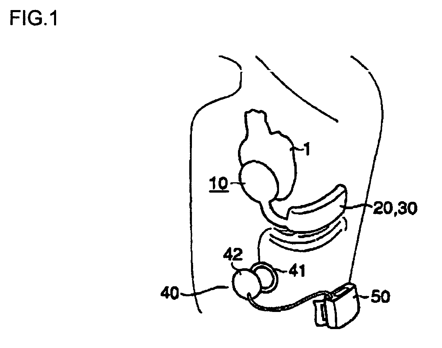 Artificial myocardial device assisting motion of heart