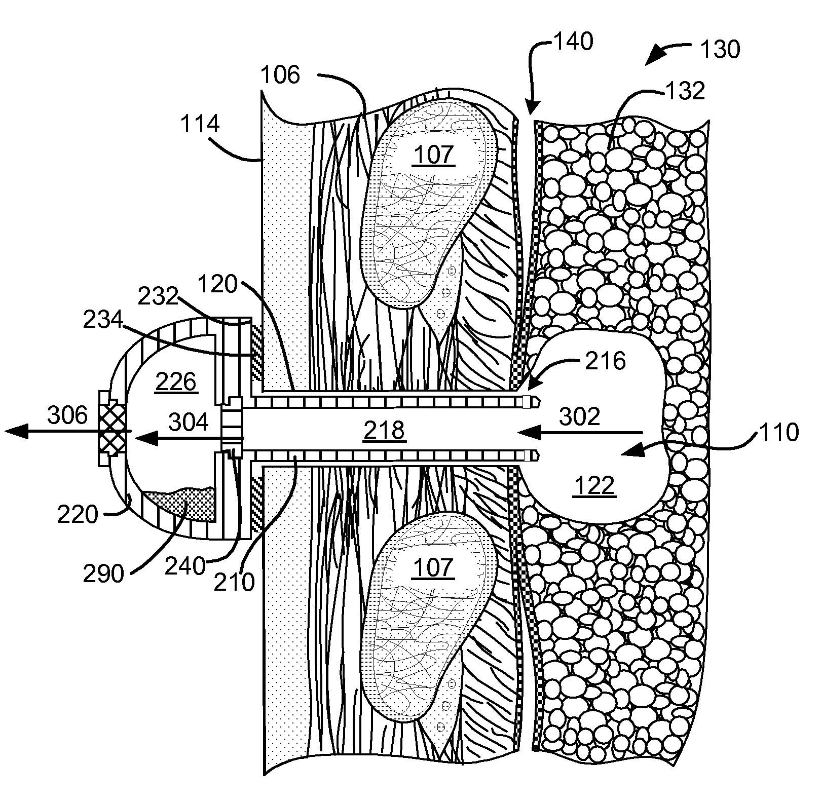 Enhanced pneumostoma management device and methods for treatment of chronic obstructive pulmonary disease