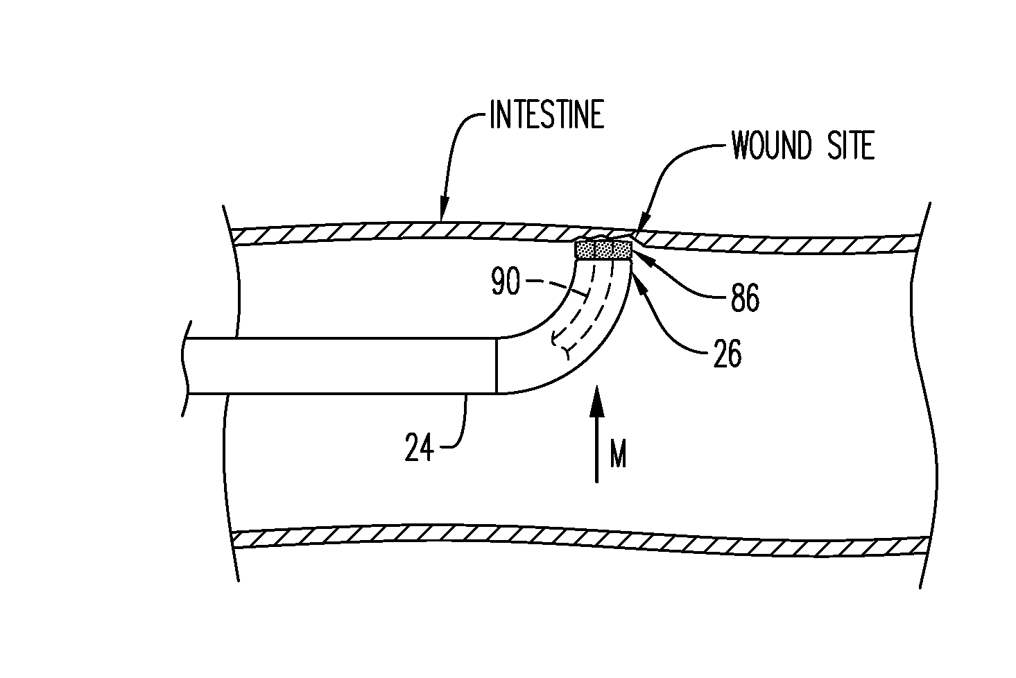 Improved Adaptive Devices and Methods for Endoscopic Wound Closures