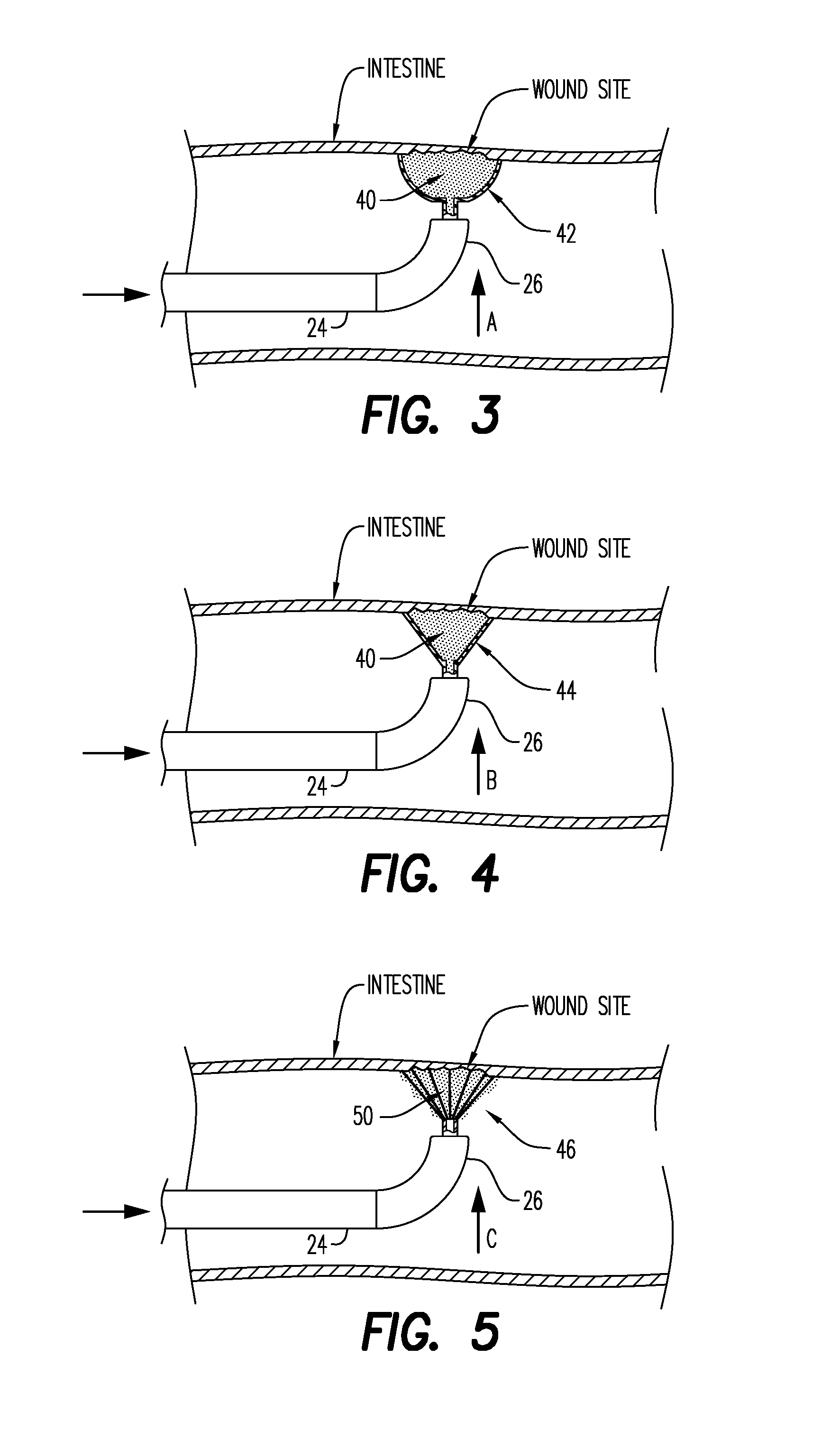 Improved Adaptive Devices and Methods for Endoscopic Wound Closures