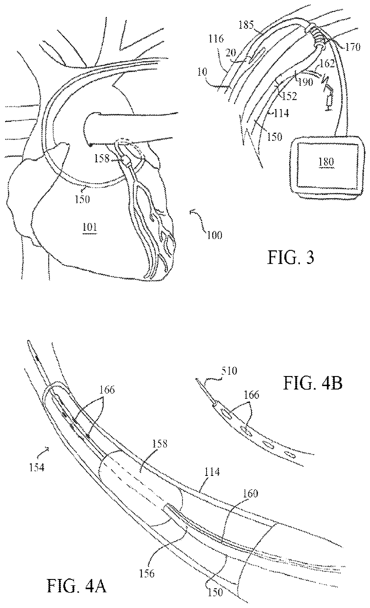 Unitary body systems and devices and methods to use the same for retroperfusion