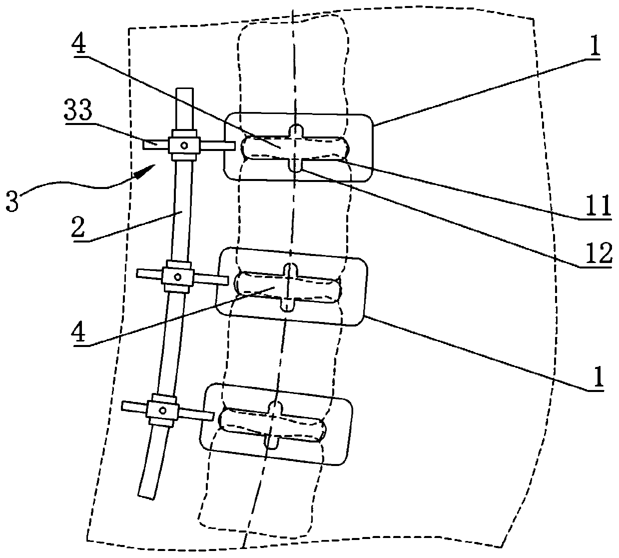Intervertebral disc surgical incision positioning device