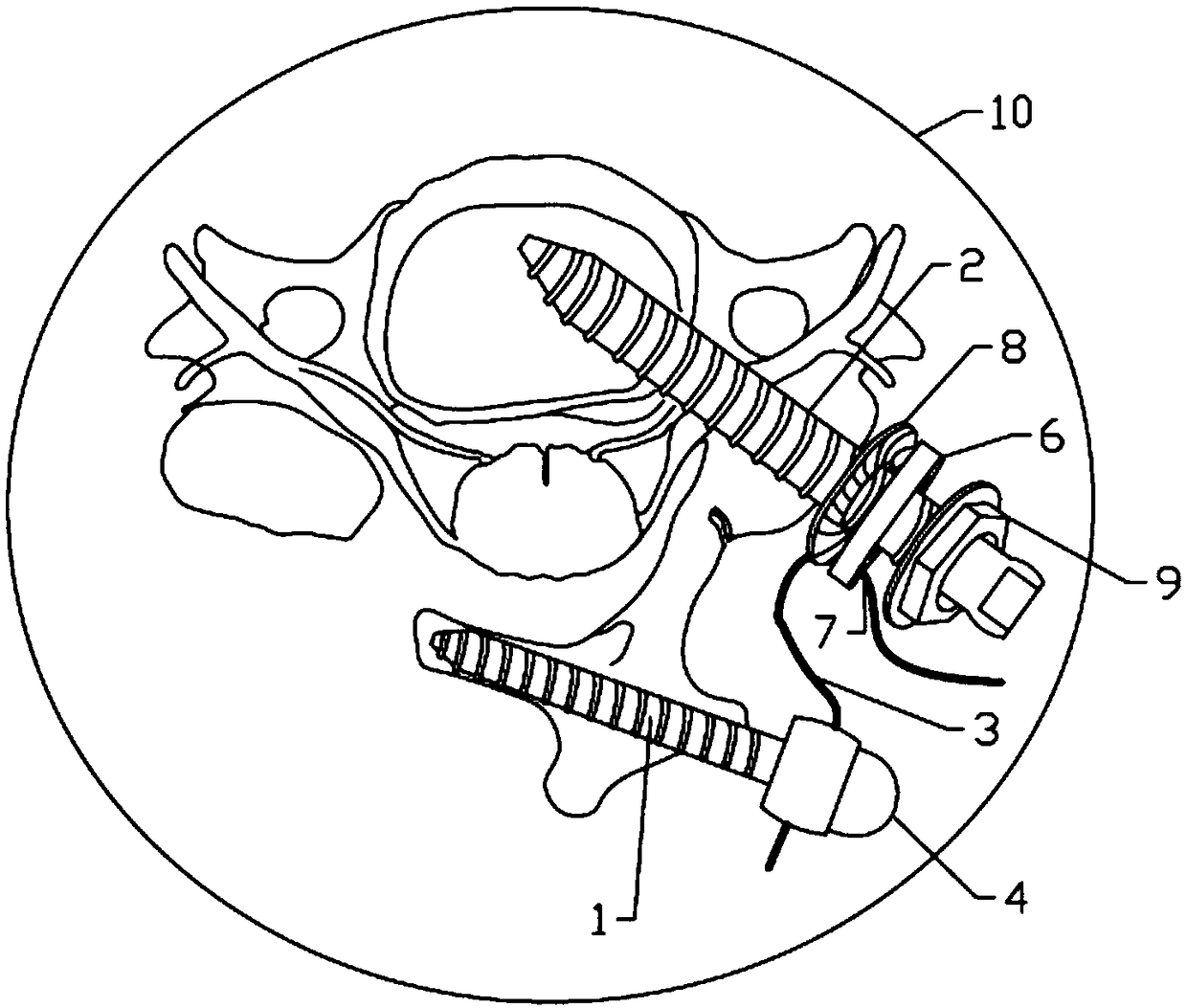 Percutaneous cervical posterior single-door internal fixation system