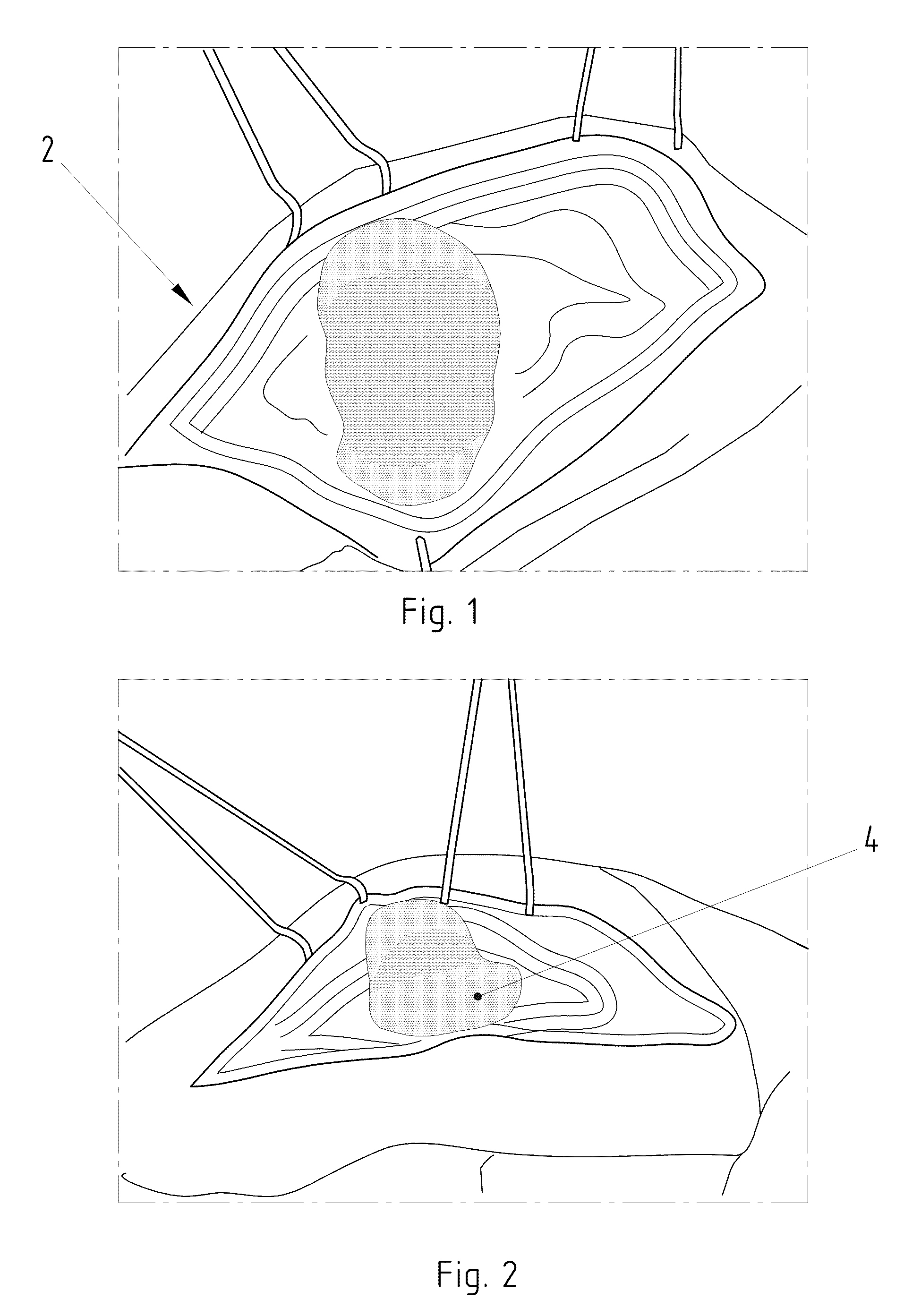 Instruments for carrying out an operating procedure on a joint