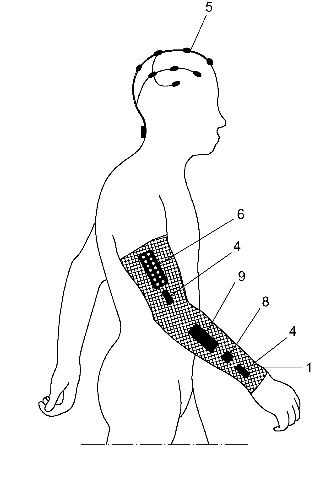 Method and neuroprosthetic device for monitoring and suppression of pathological tremors through neurostimulation of the afferent pathways