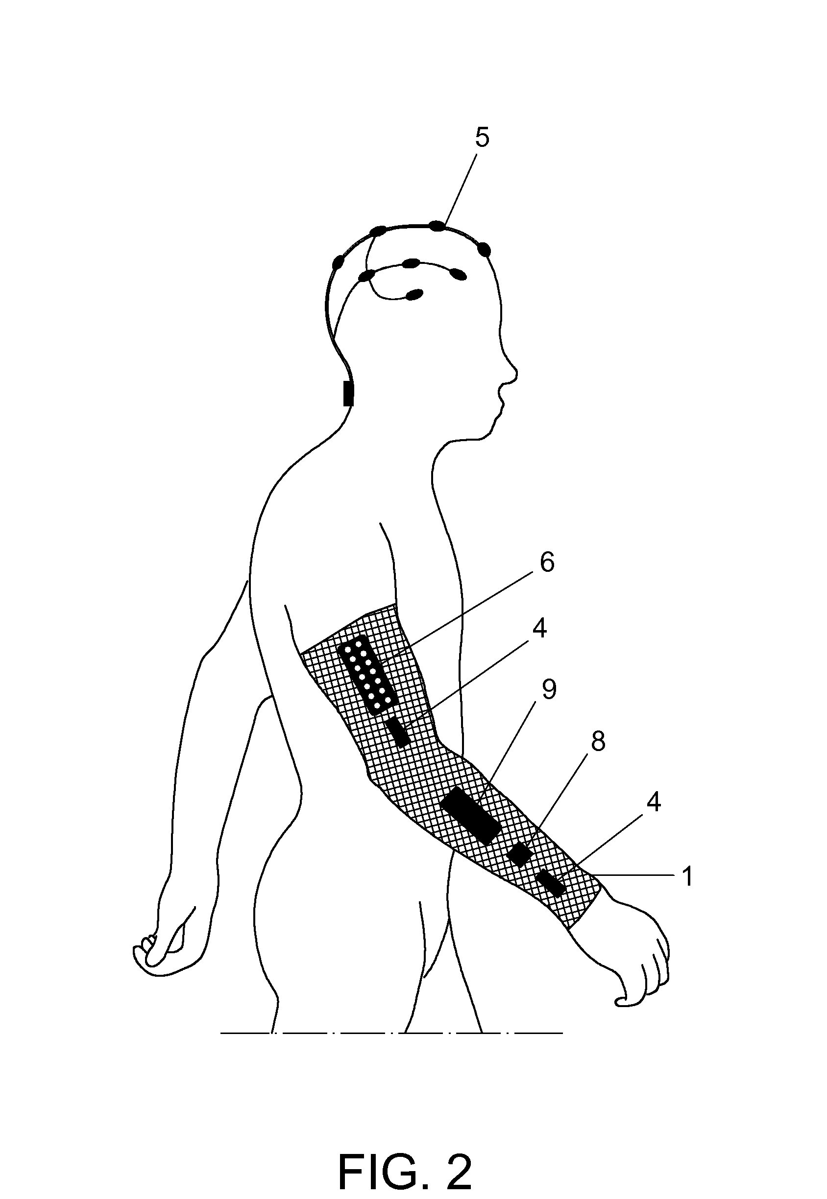 Method and neuroprosthetic device for monitoring and suppression of pathological tremors through neurostimulation of the afferent pathways