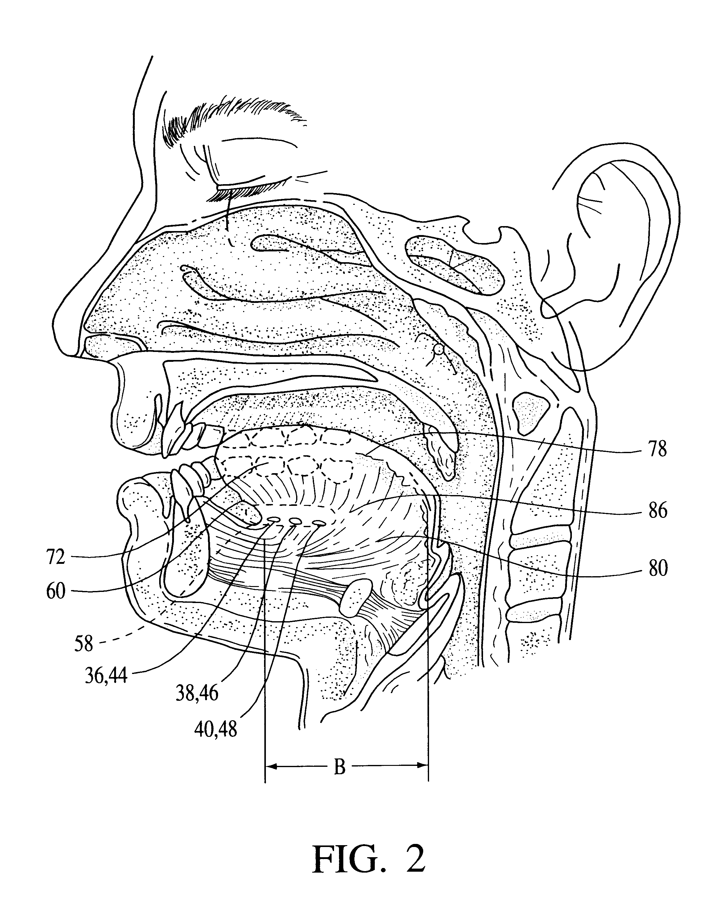 Intraoral electromuscular stimulation device and method