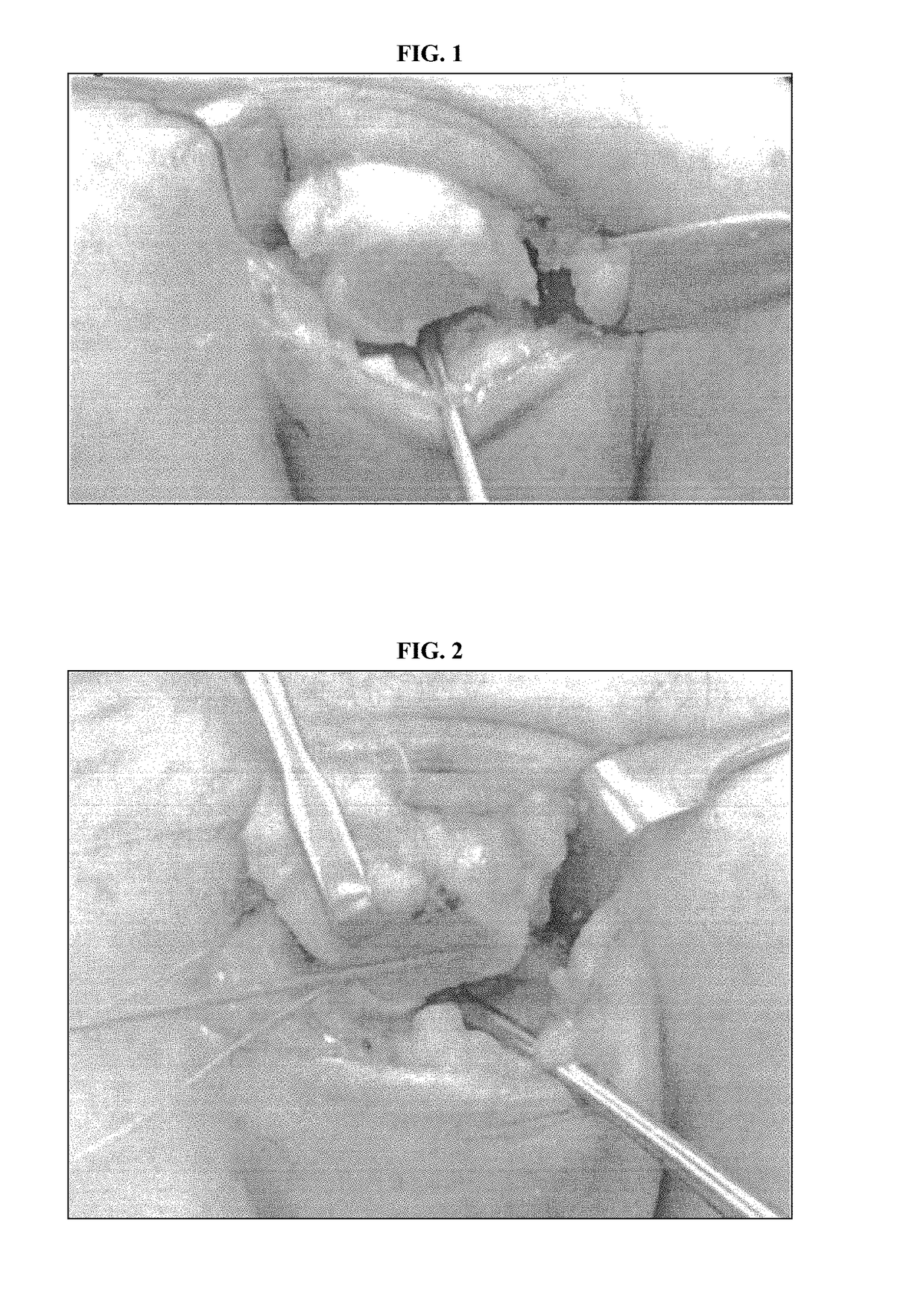 Meniscus for joint reconstruction