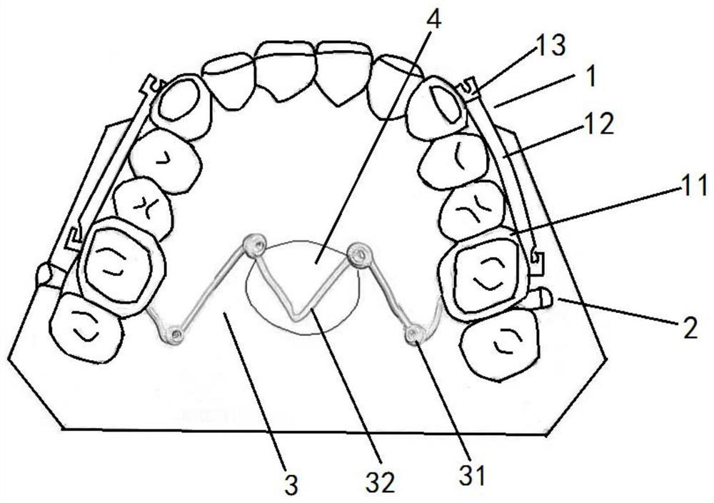 Device for distally moving posterior dentition