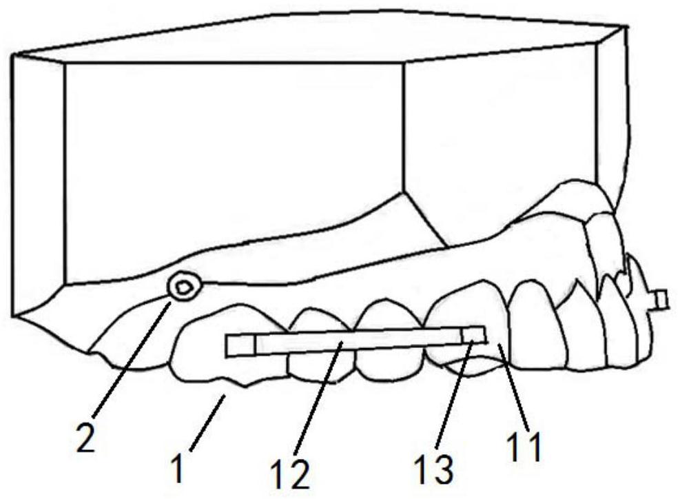 Device for distally moving posterior dentition