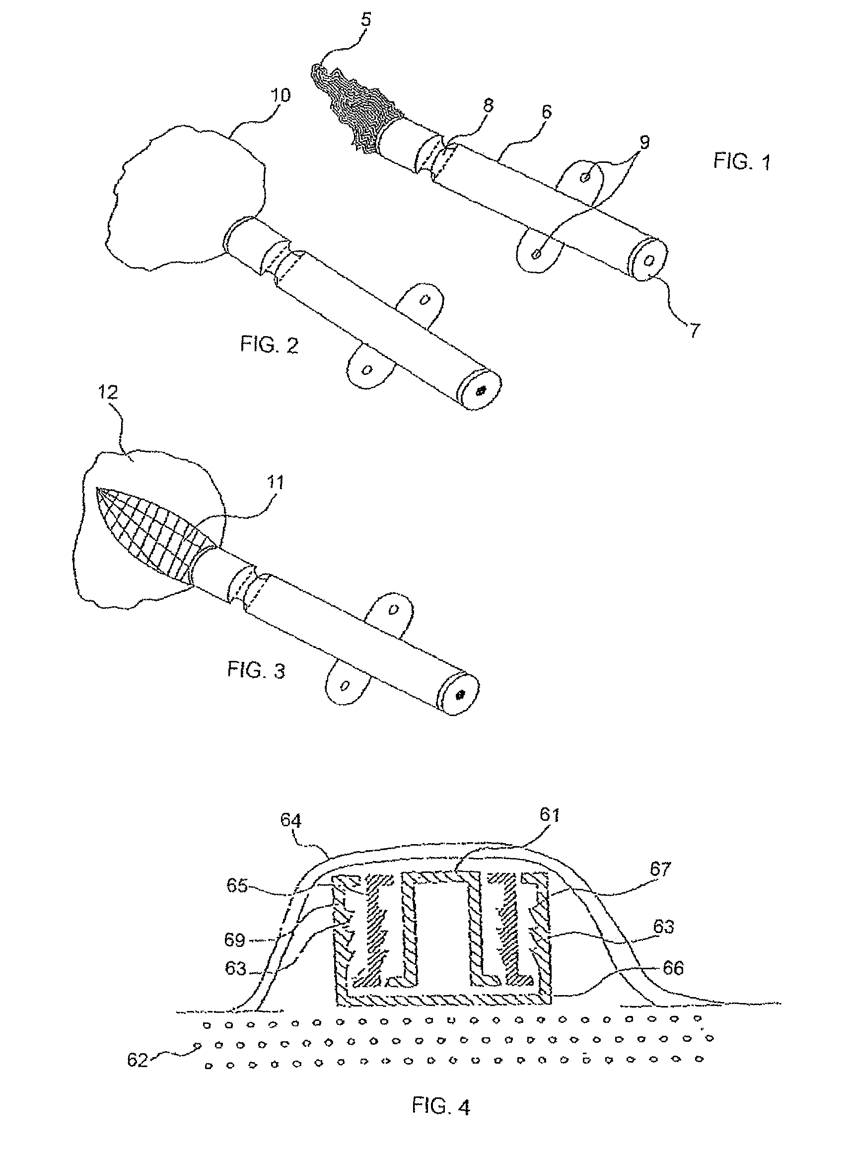 Method for enlarging a jaw bone using a hollow dental implant having a side perforation