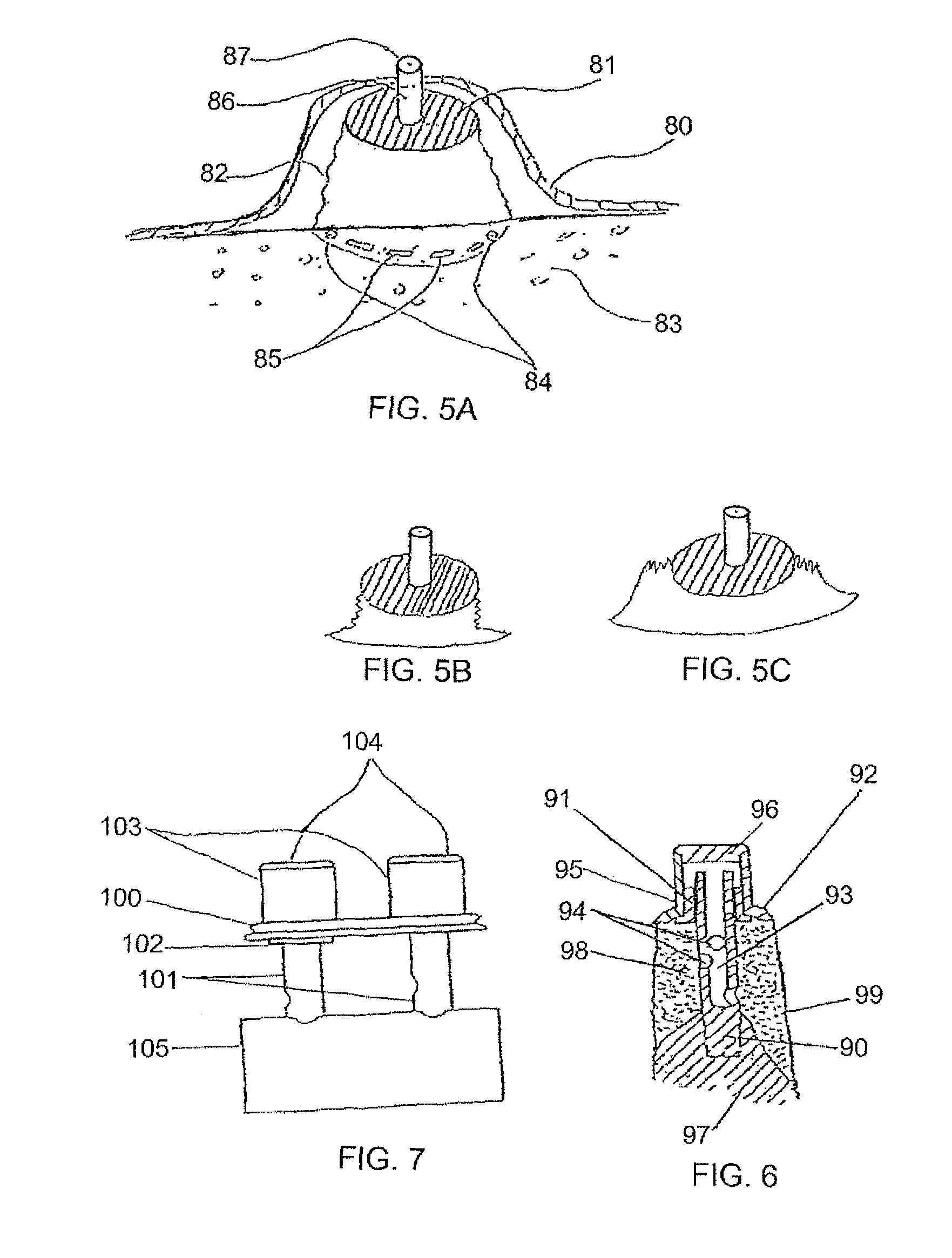 Method for enlarging a jaw bone using a hollow dental implant having a side perforation