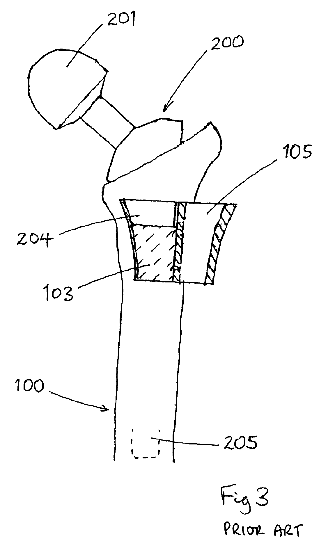 Femoral implant revision tool