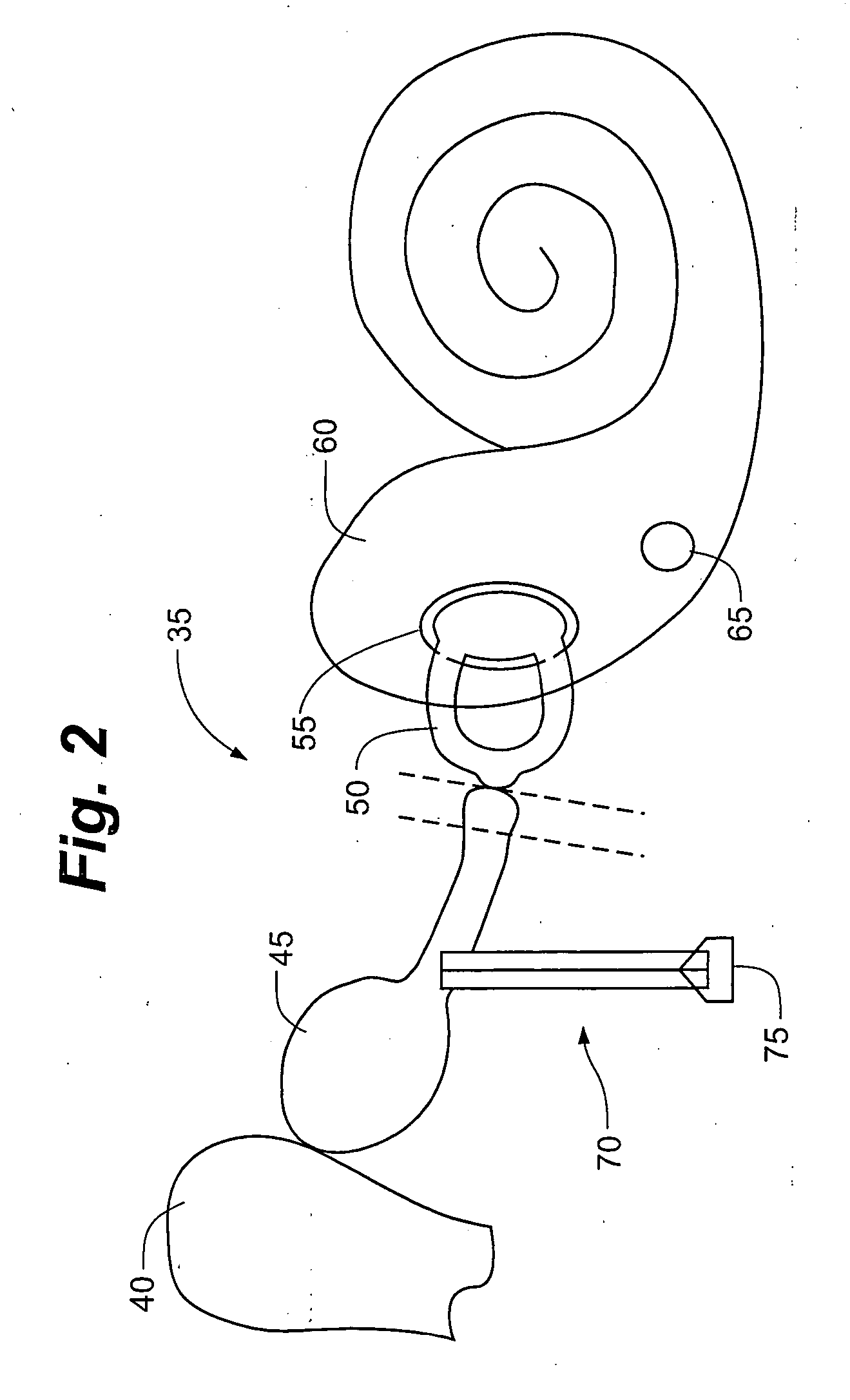 Method and apparatus for minimally invasive placement of sensing and driver assemblies to improve hearing loss