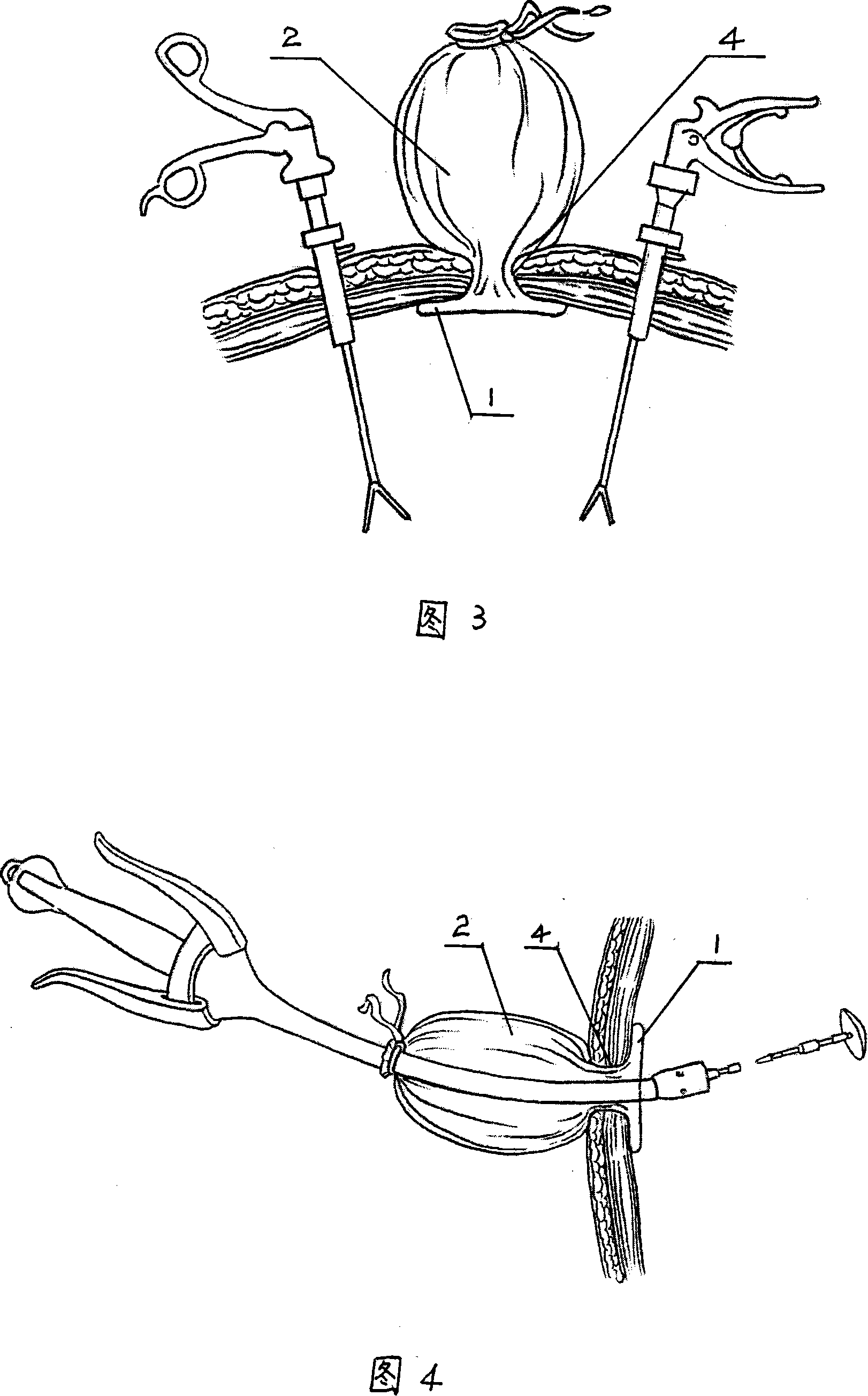 Device for sealing abdominal wall lancing for peritoneoscope operation