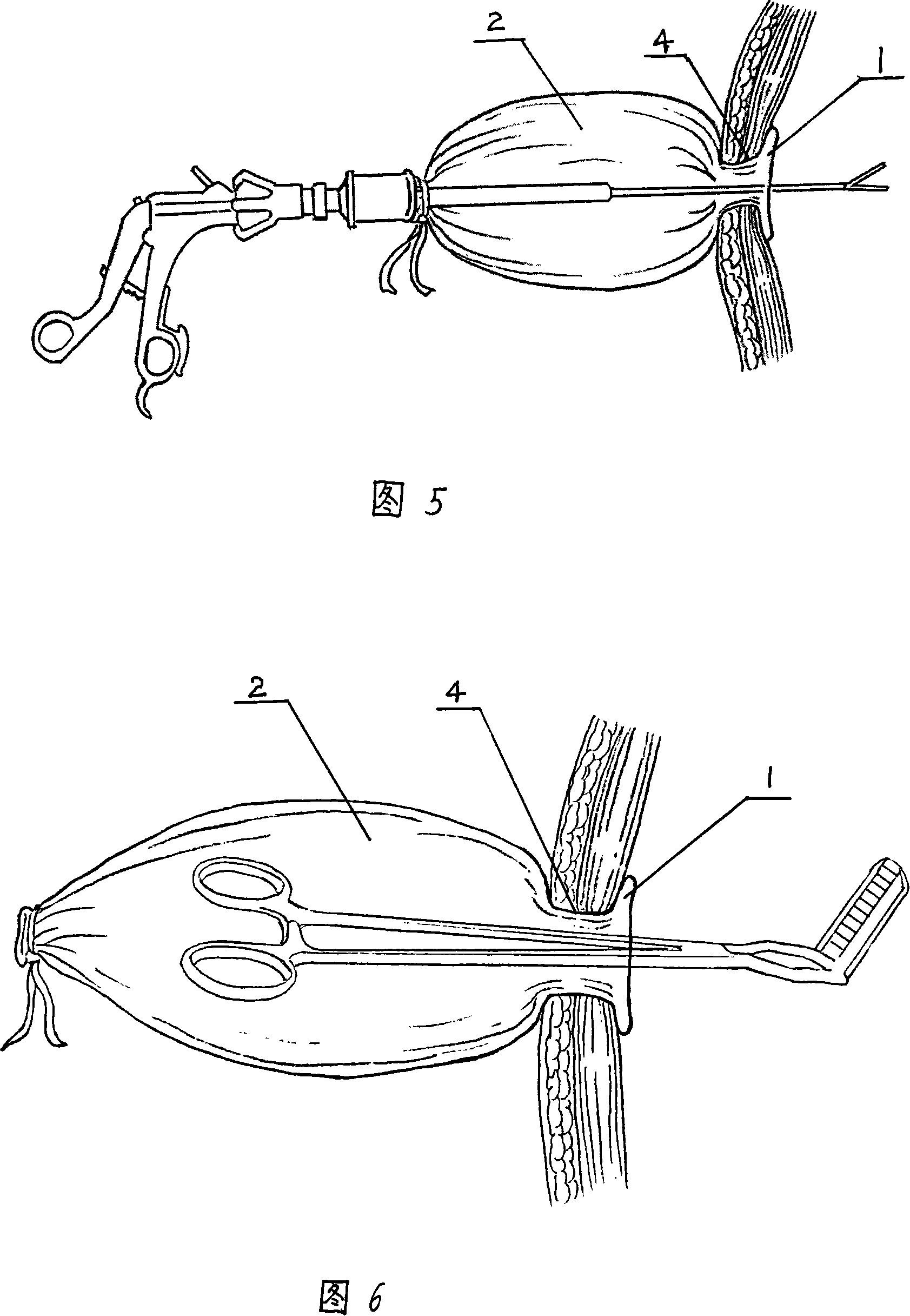 Device for sealing abdominal wall lancing for peritoneoscope operation