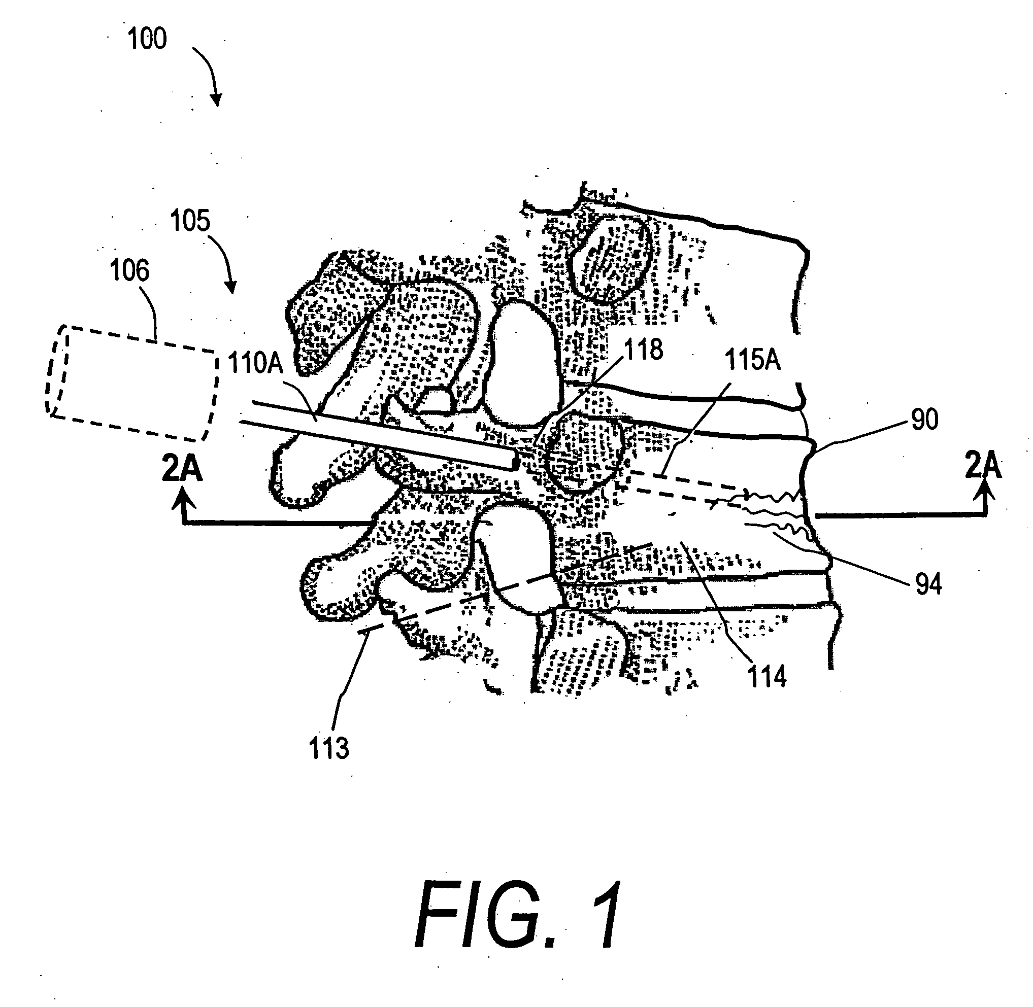 Bone treatment systems and methods