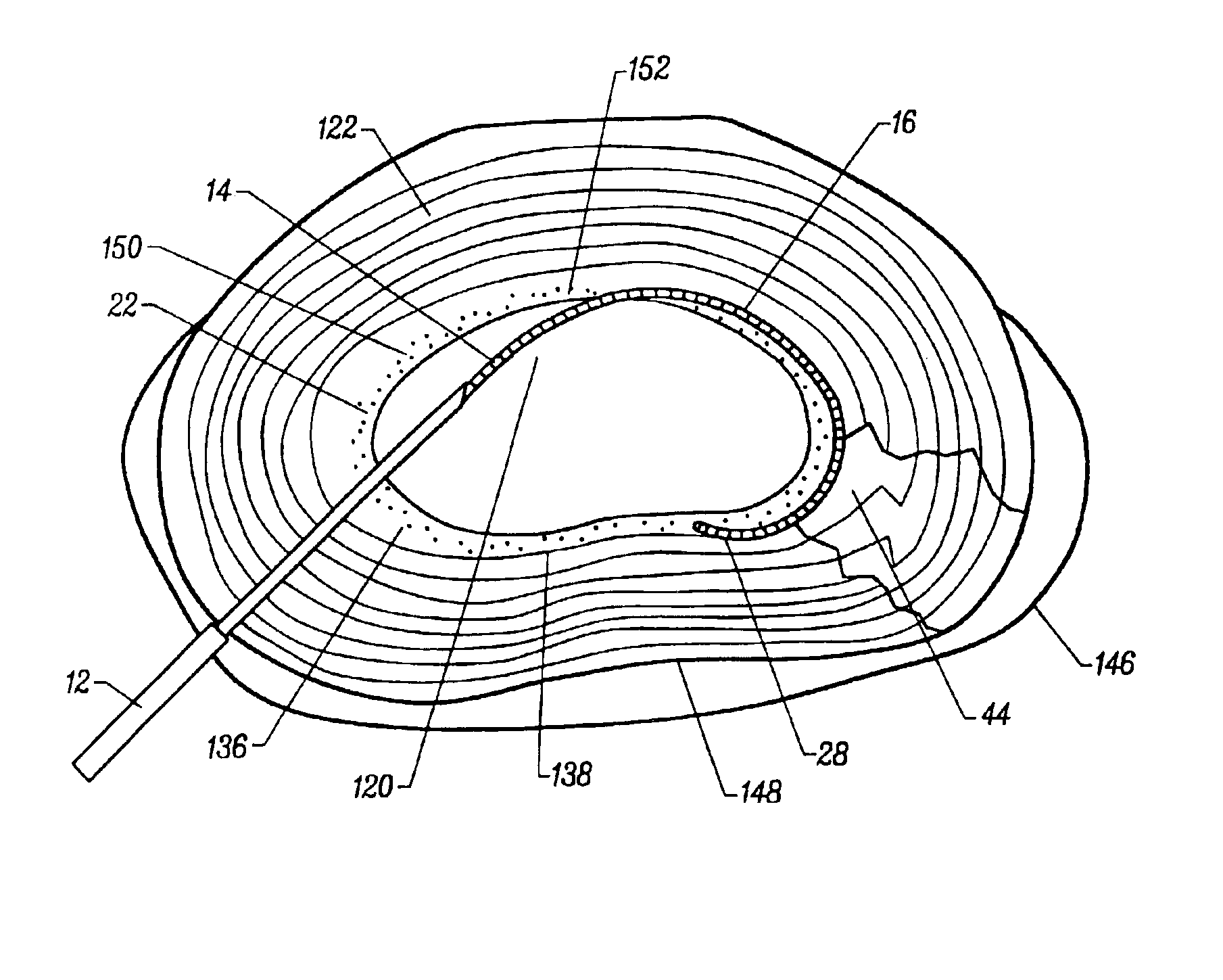 Method and apparatus for treating annular fissures in intervertebral discs