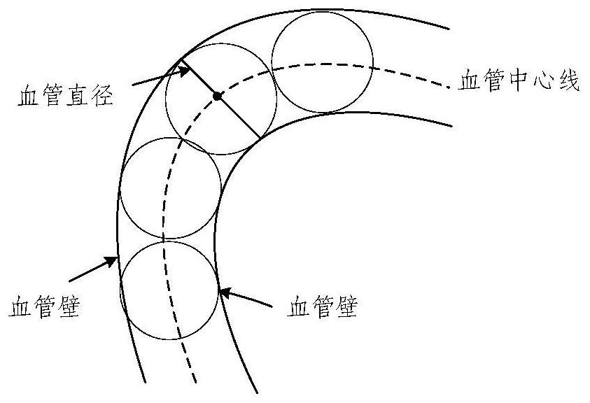 A method for identifying the degree of local vascular stenosis in dsa coronary images