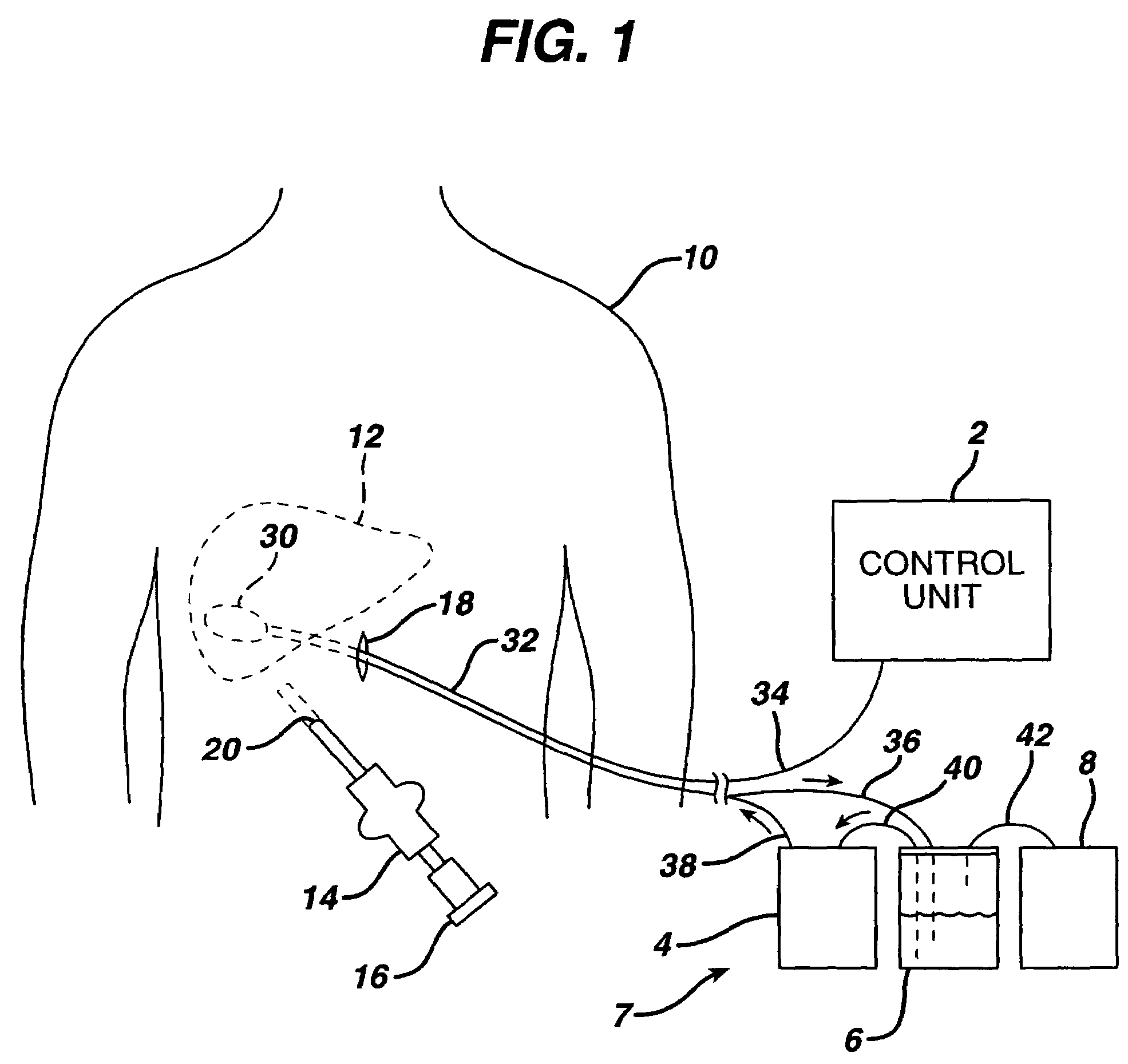 Medical device that removably attaches to a bodily organ