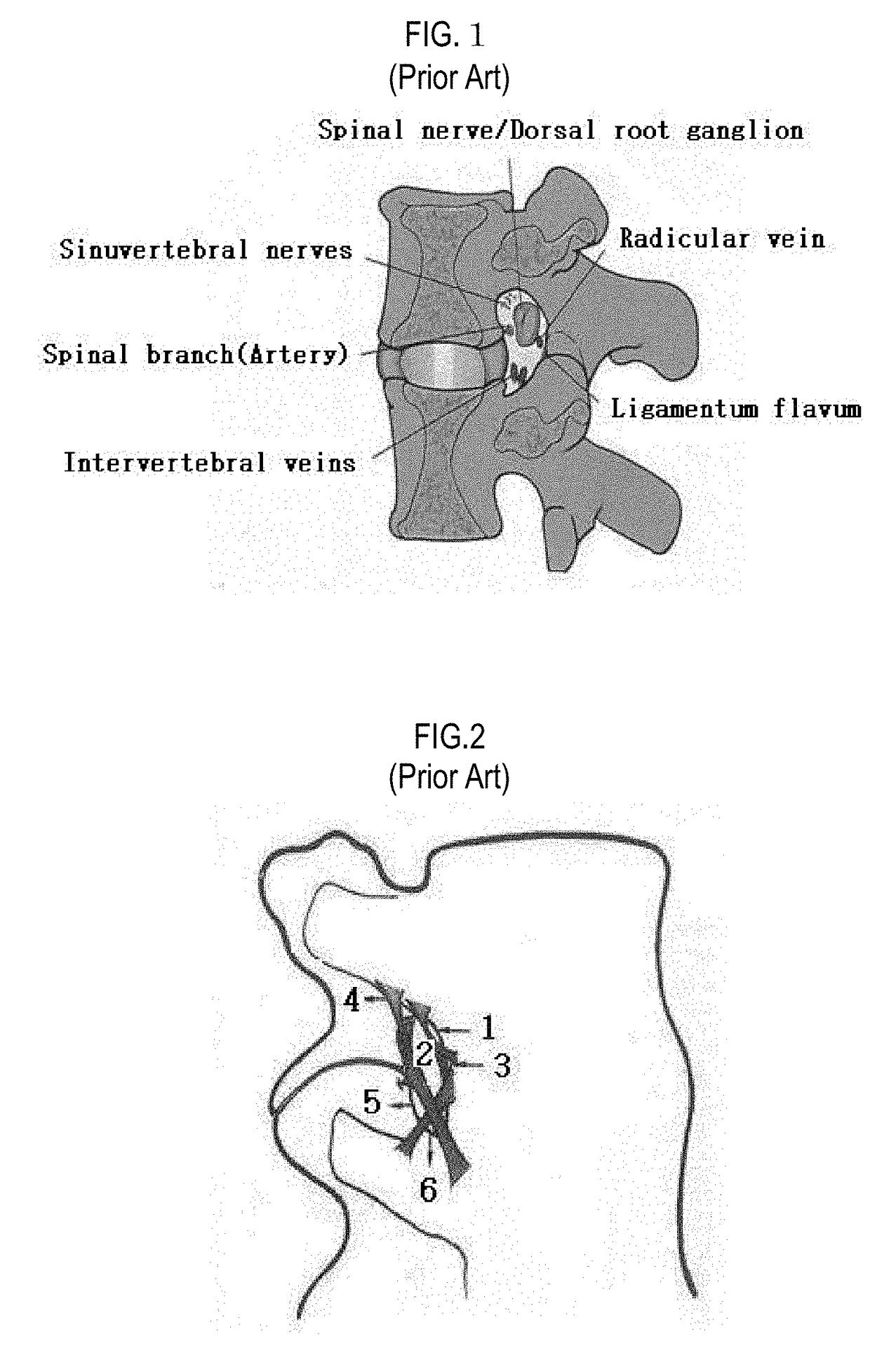 Instrument tools for performing percutaneous extraforaminotomy with foraminal ligament resection