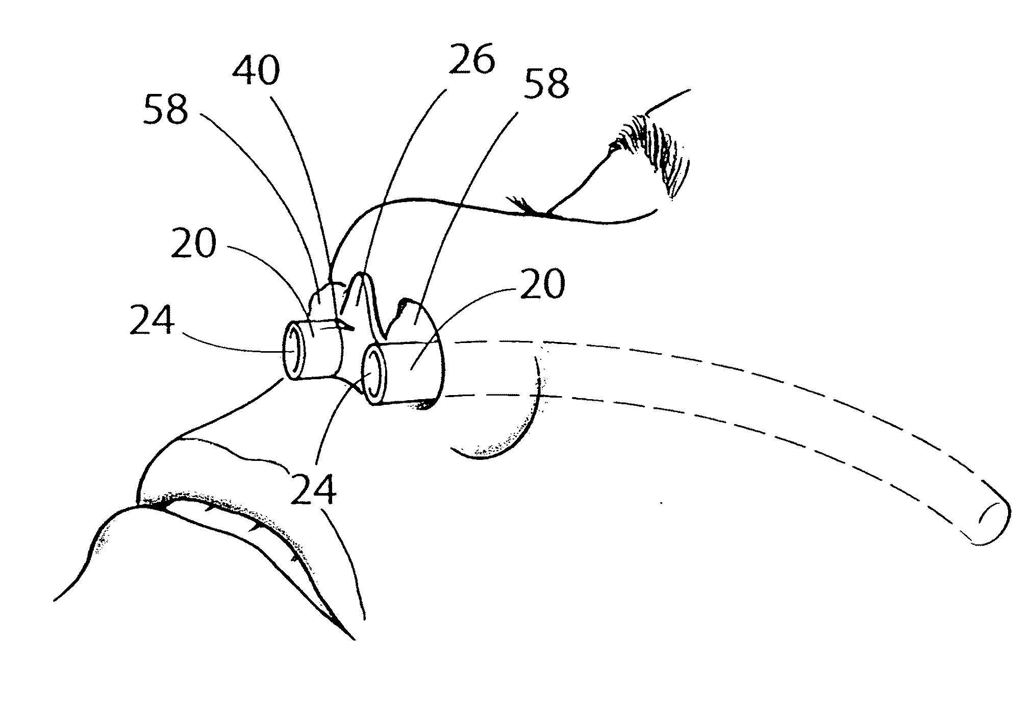 Device and method for maintaining unobstructed nasal passageways after nasal surgery