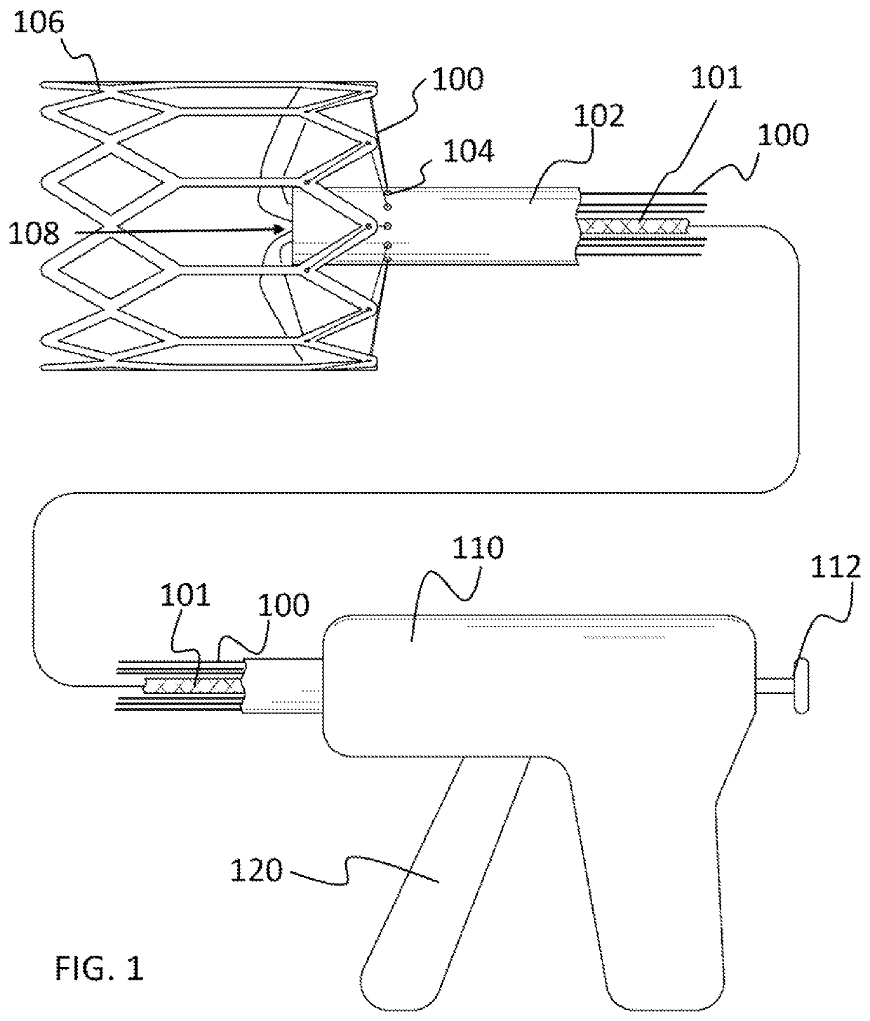 Delivery system for transcatheter detachment of a stent from the delivery device