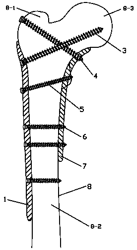 Combined splint internal fixation device for femoral intertrochanteric fracture and auxiliary aiming apparatus