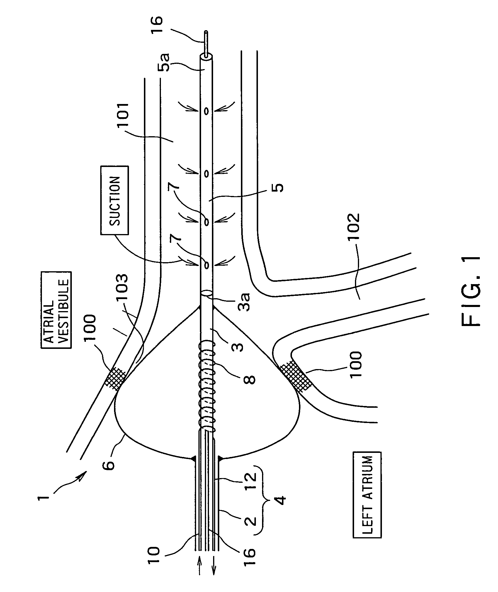 Radio-frequency heating balloon catheter