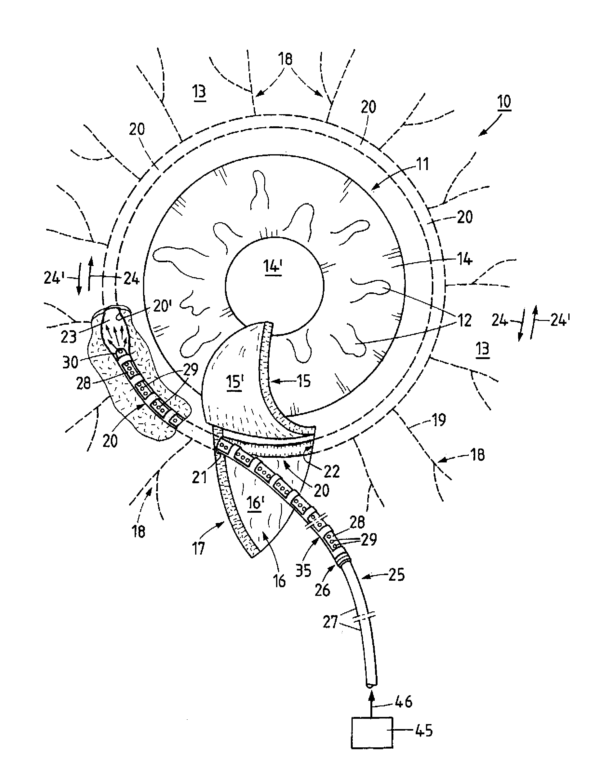 Method and device for the treatment of glaucoma