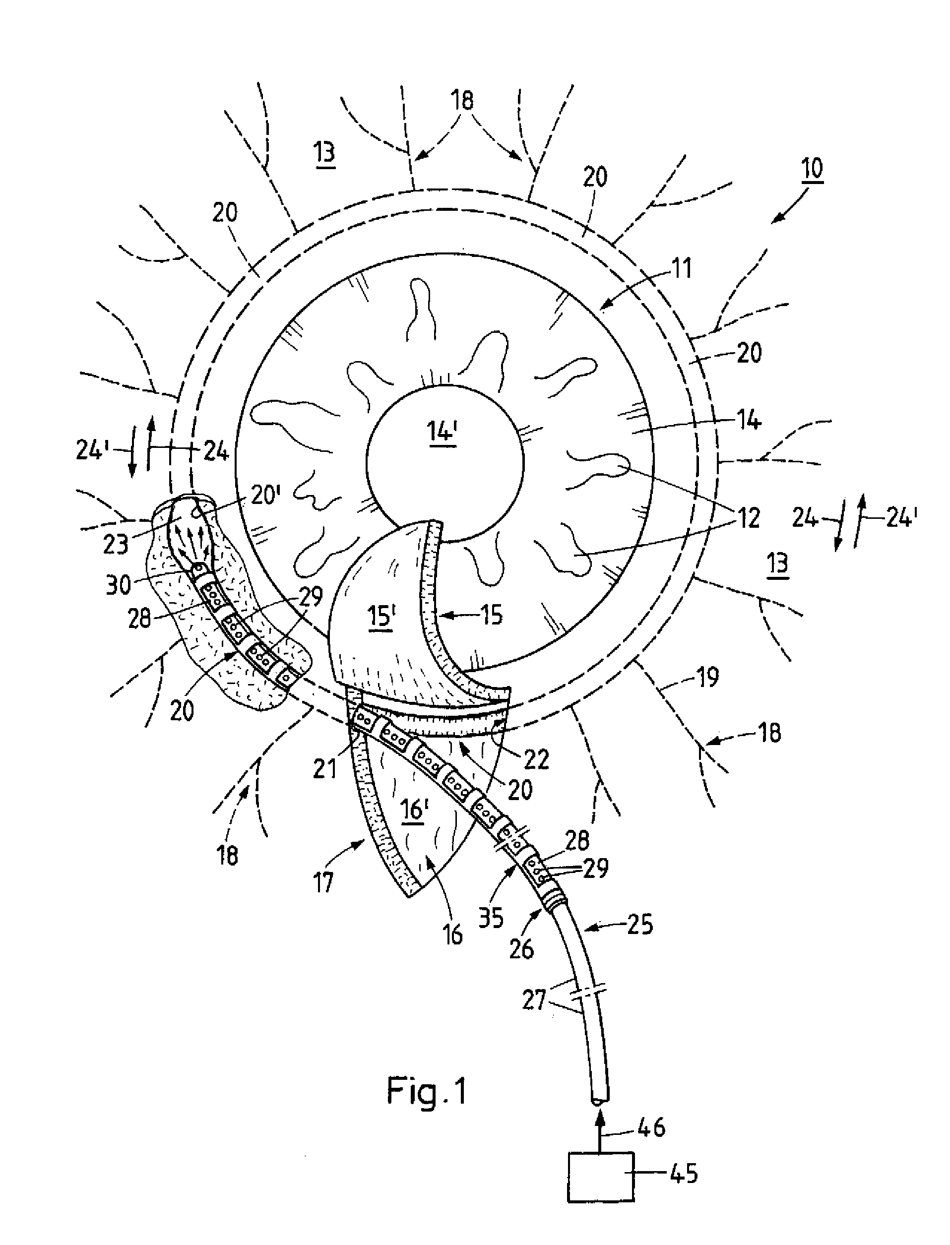 Method and device for the treatment of glaucoma